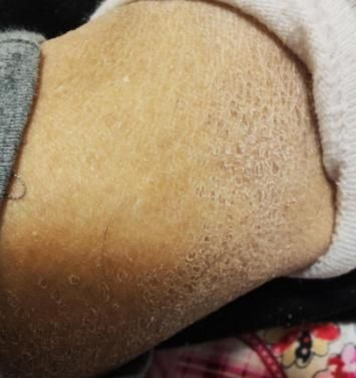 一到冬天身上腿上起皮怎么回事?