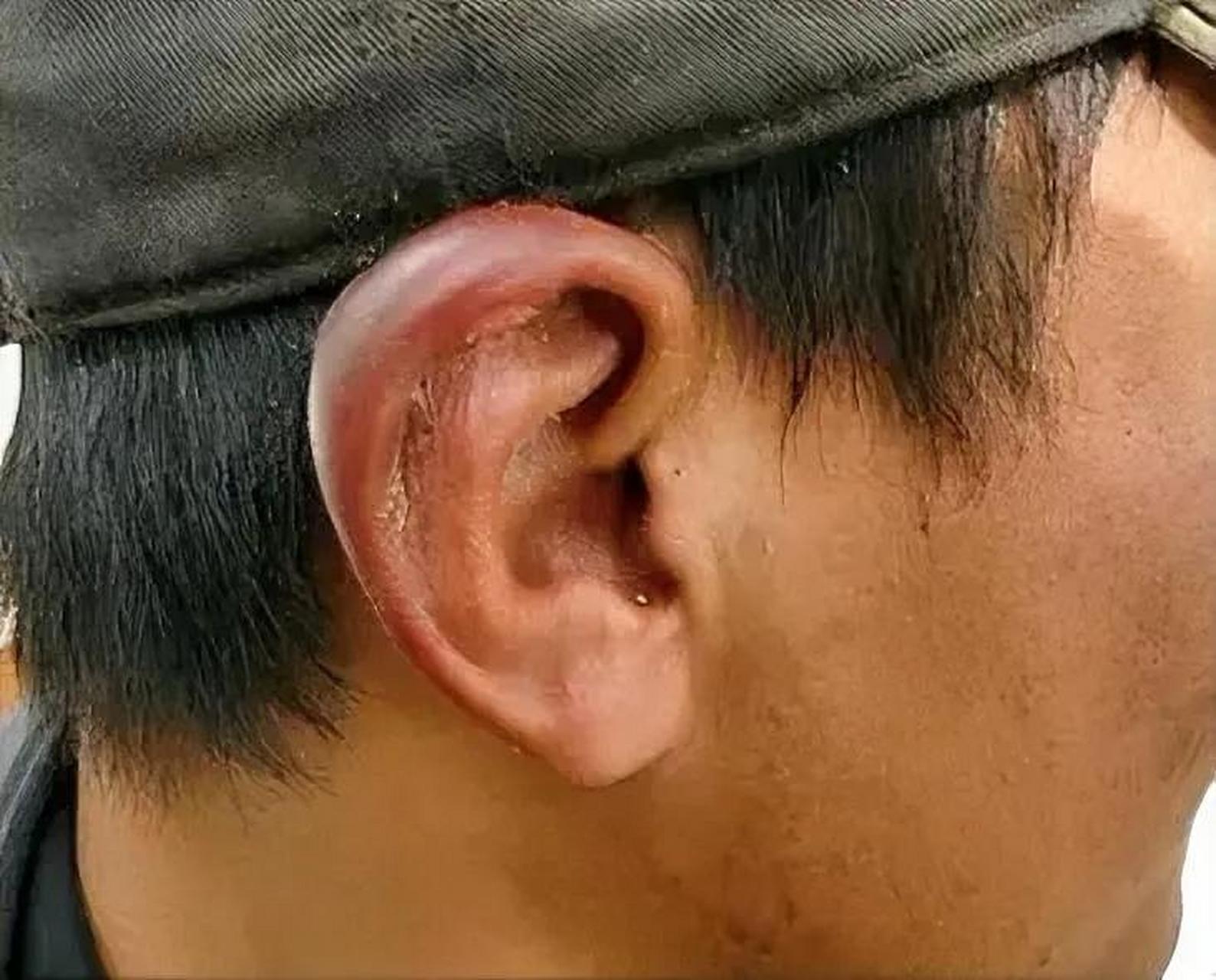 一到冬天,有的人耳朵会莫名发烫,然后引起冻疮,那么耳朵为什么这么