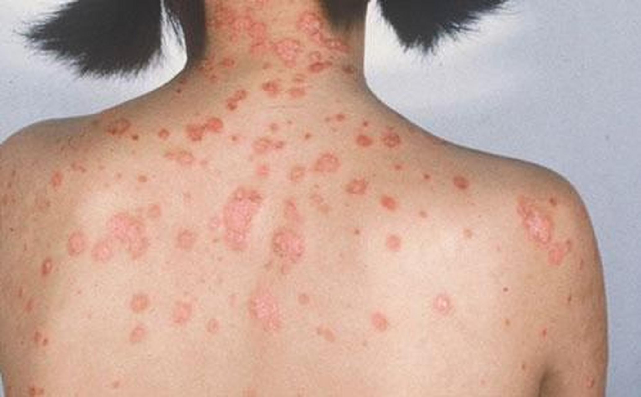 亳州有没有专业银屑病医院# 银屑病复发的症状是什么?