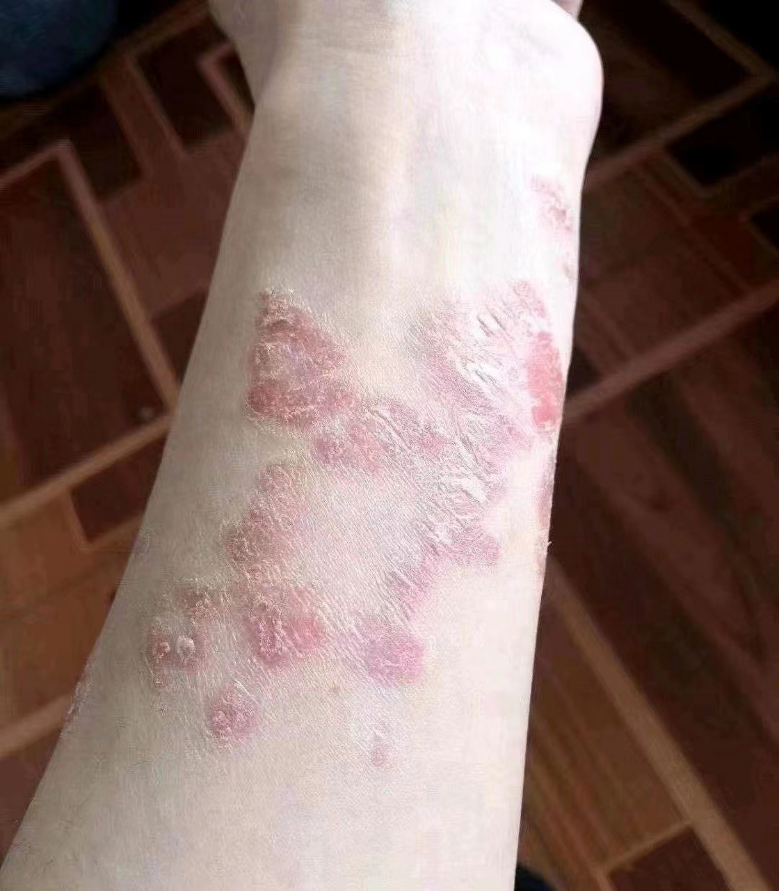 困扰多年的牛皮癣,还有希望治好吗?