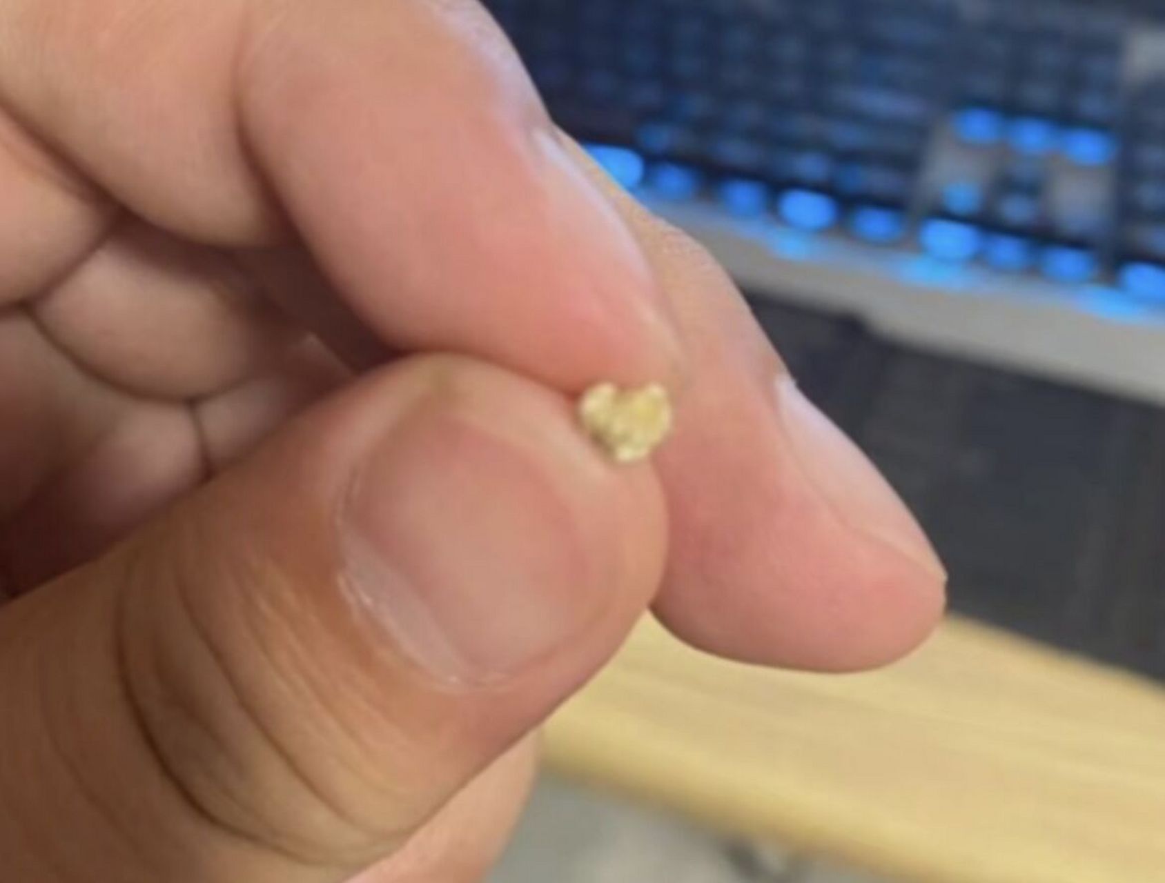 5mm输尿管结石排出,从发现后患者就一直坚持运动喝水,一周就把输尿 