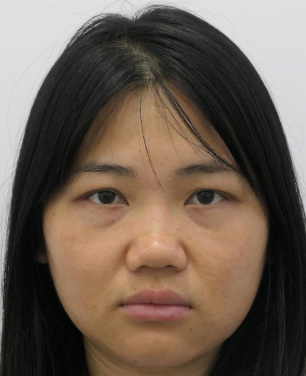 今天给大家分享一个"肉肉"鼻的矫正案例图,术后可以看到鼻子有流畅的