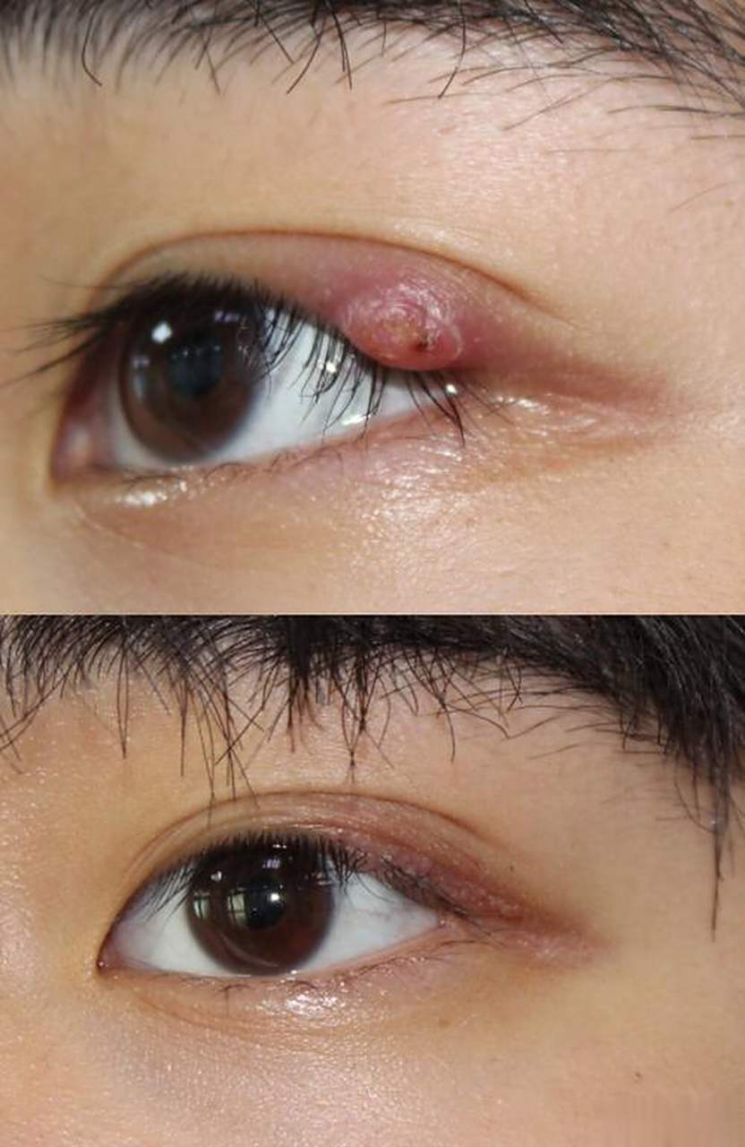 中医基础知识;针眼,的病因病机是什么?