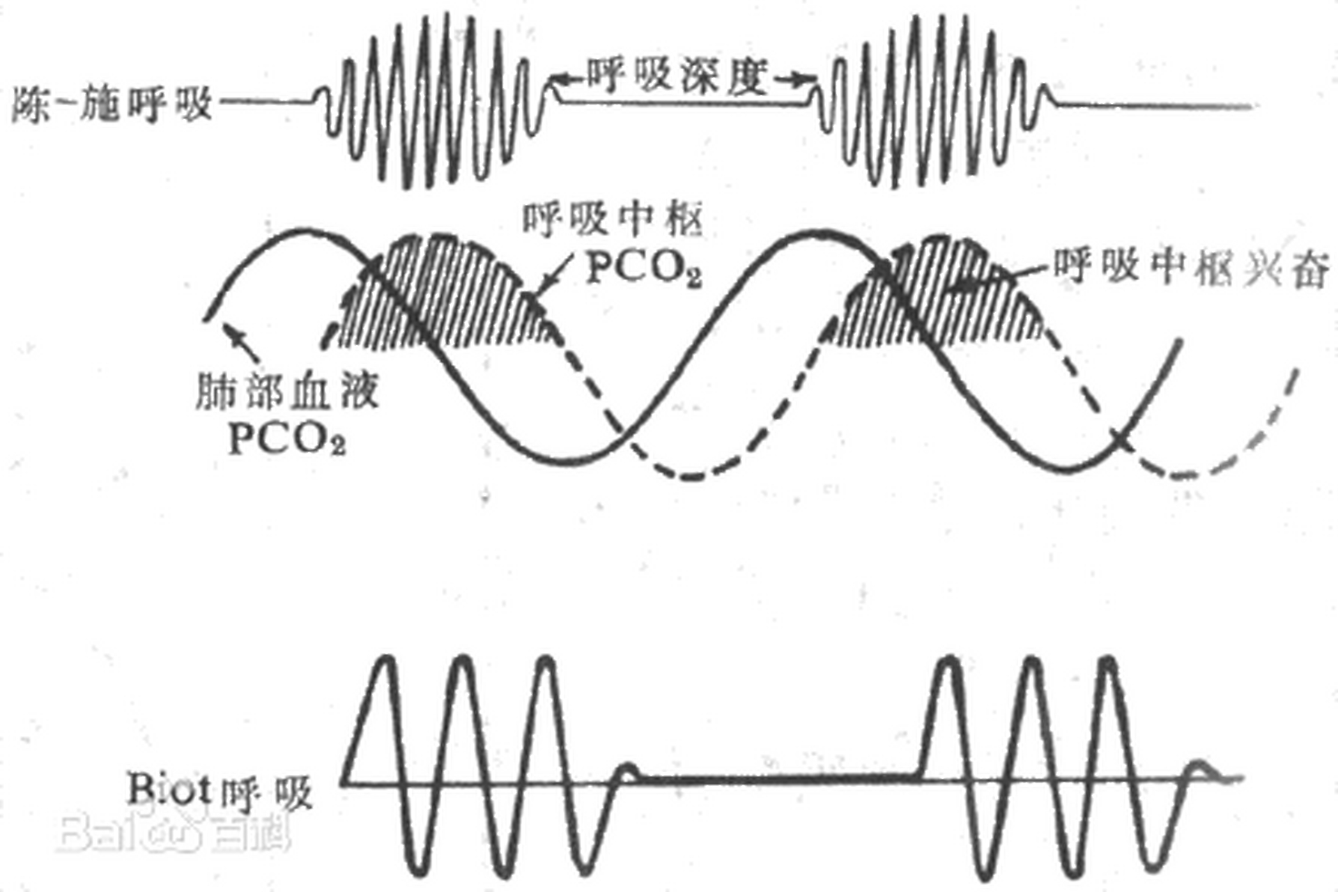 潮式呼吸波形变化如潮水涨落样,因此被称为潮式呼吸.