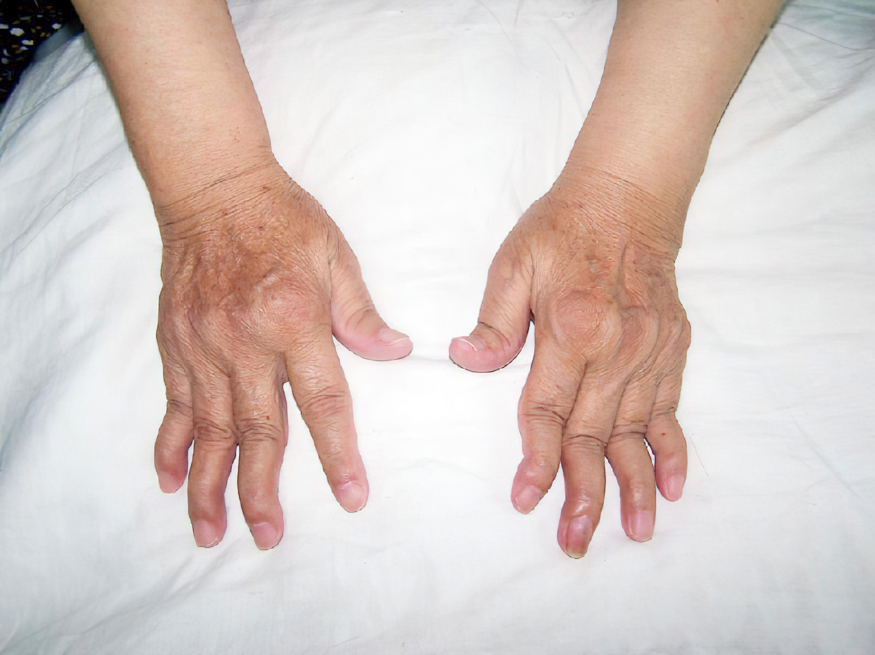 类风湿性关节炎关节畸形怎么回事怎么办?