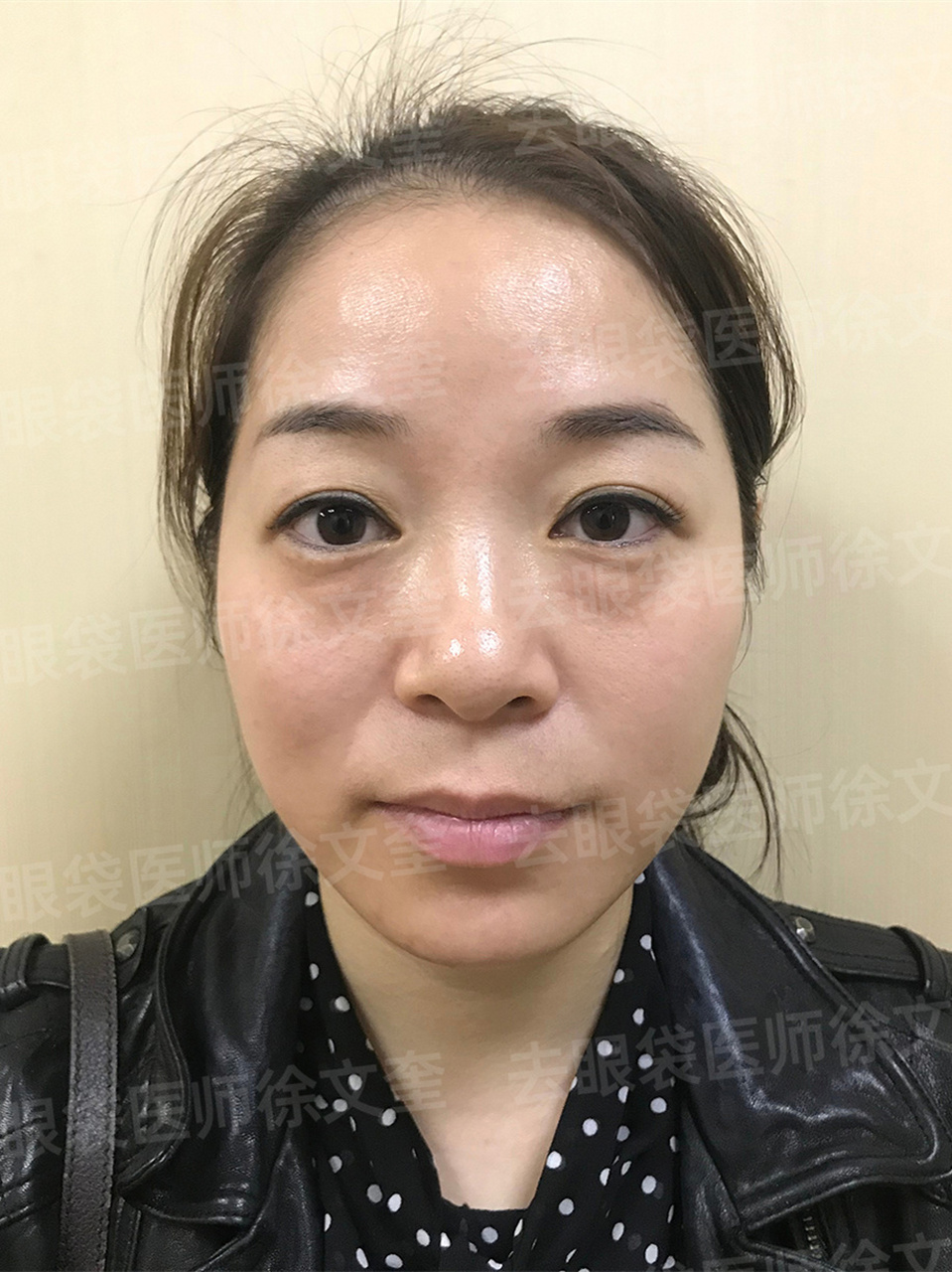 泪沟凹陷,眼袋明显是很多30 人群面临的问题,就如今天的案例.