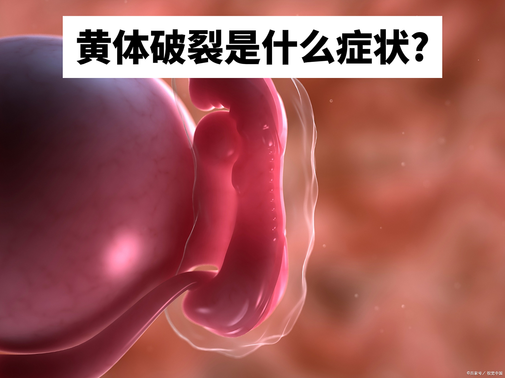 [中国加油]黄体破裂是指在排卵后,黄体形成并逐渐增大,在黄体增大的