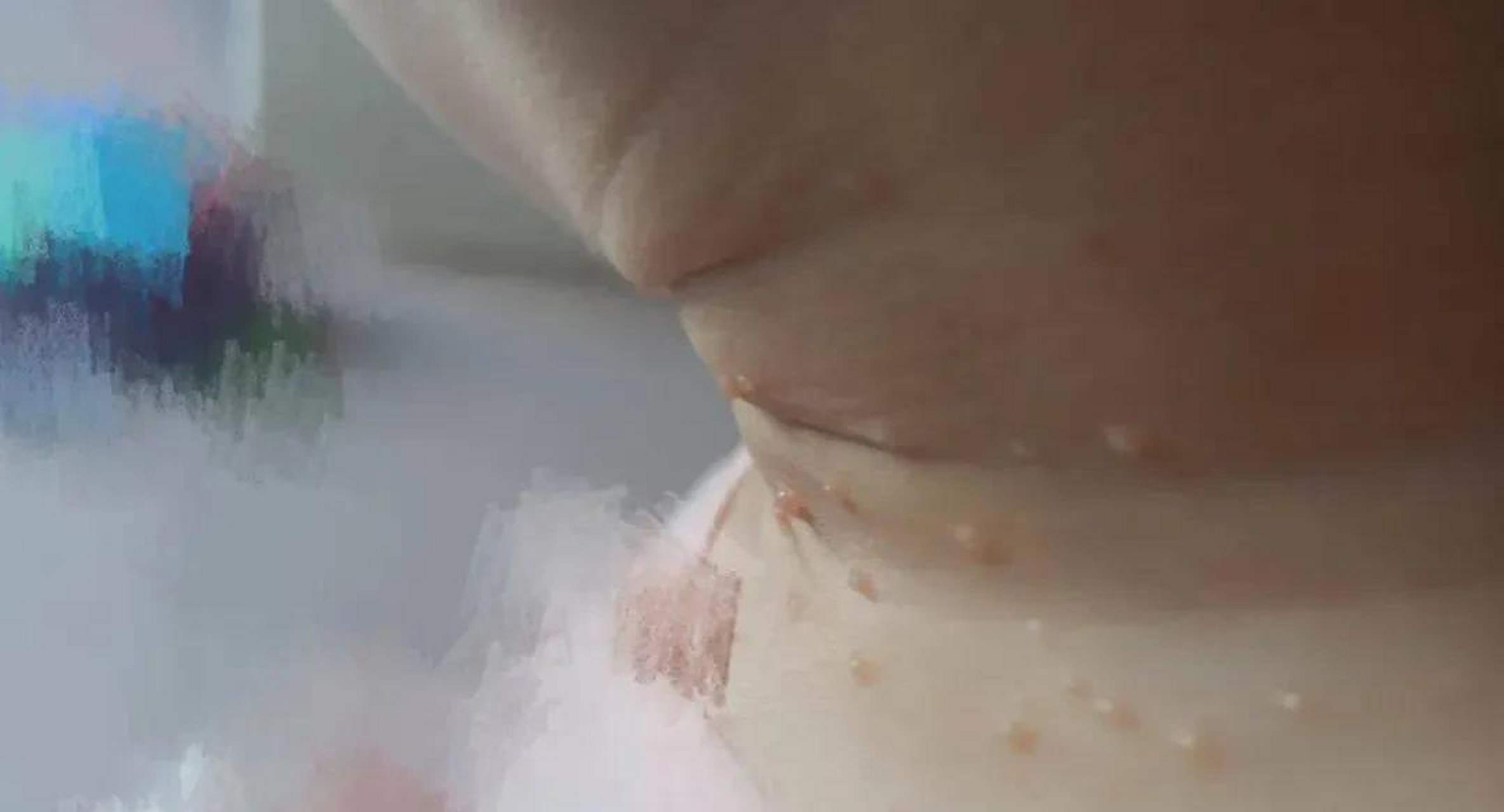 今天看了一个小女孩,自诉外阴处长了类似水痘的疙瘩,是接触男朋友后才