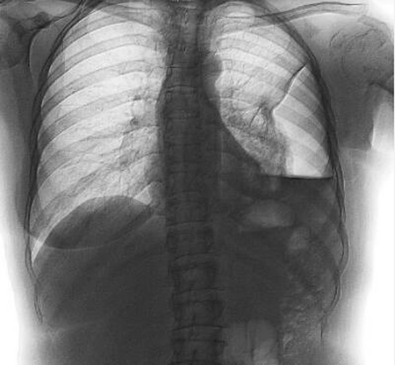 看个片儿:左侧液气胸 67676767