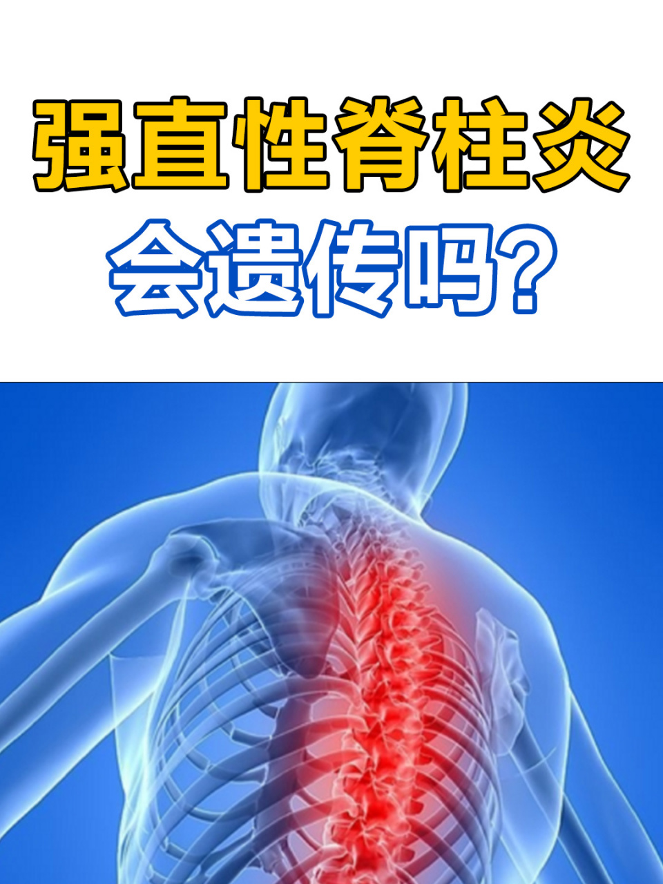 强直性脊柱炎会遗传吗图片