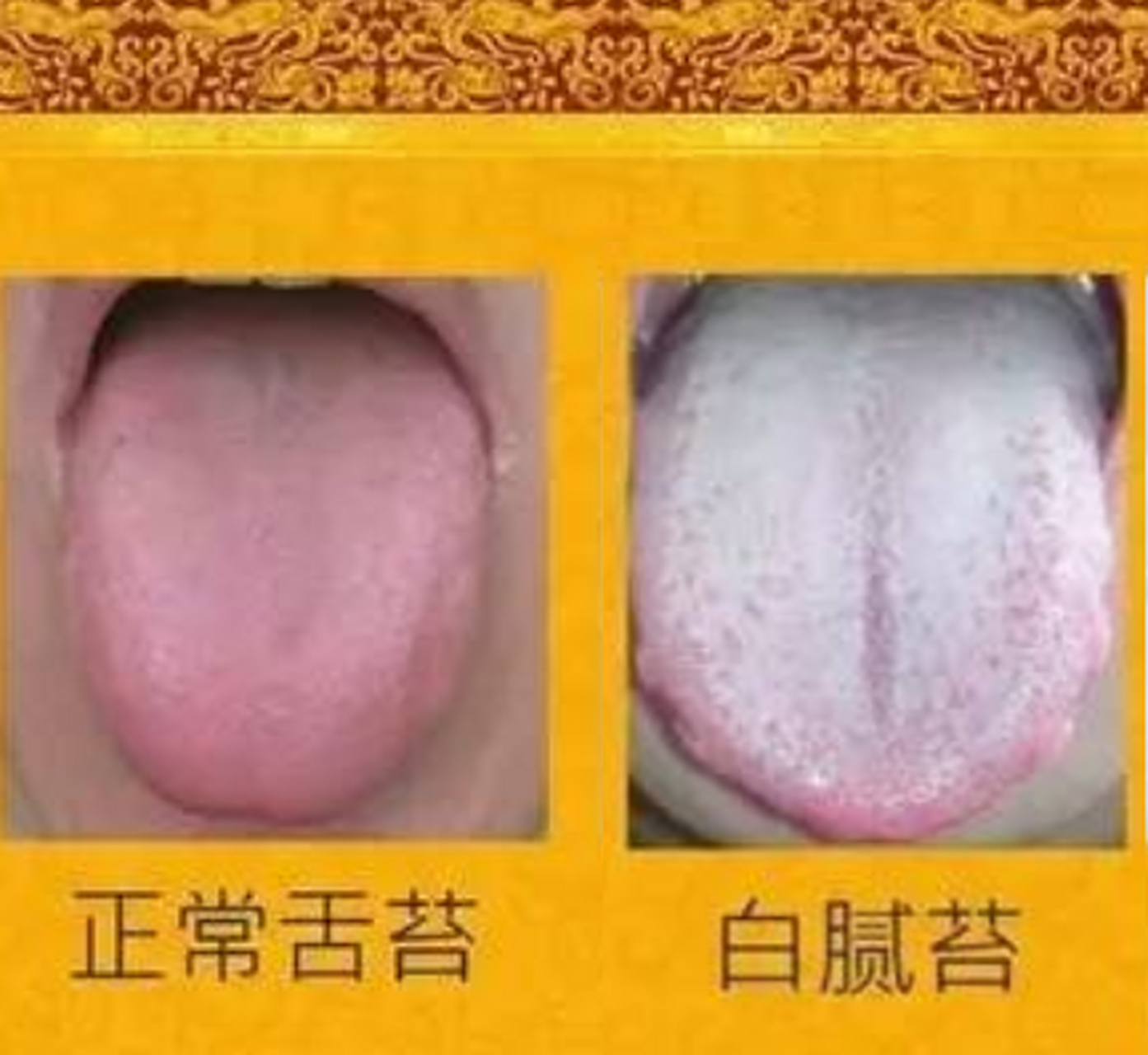 舌苔白腻而厚,可能是这3种原因引起的 1,上火:主要是因为水分摄入过少