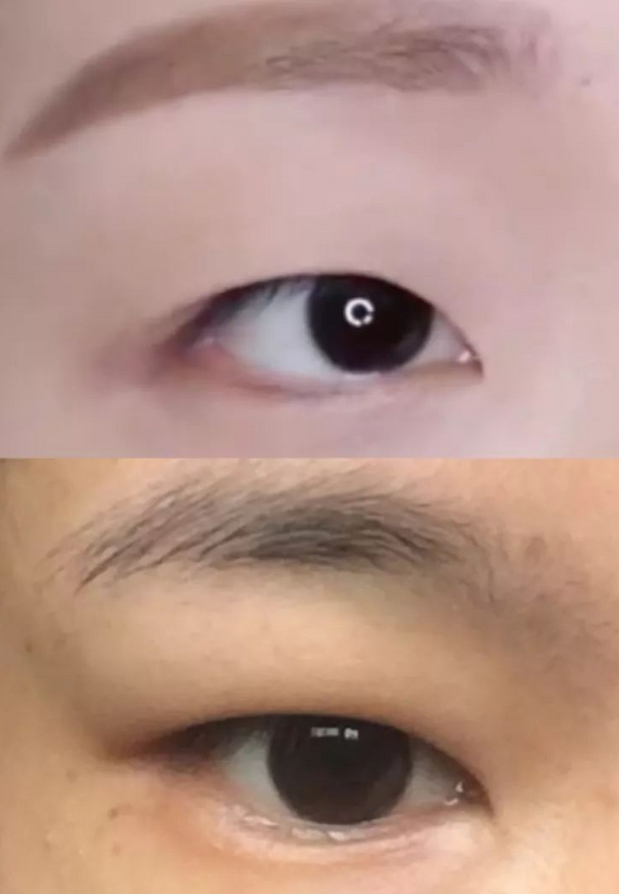 眼部综合# 天生肿眼泡怎么改善?
