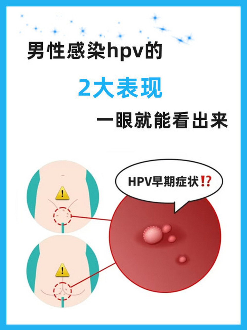 hpv男性早期症状图片