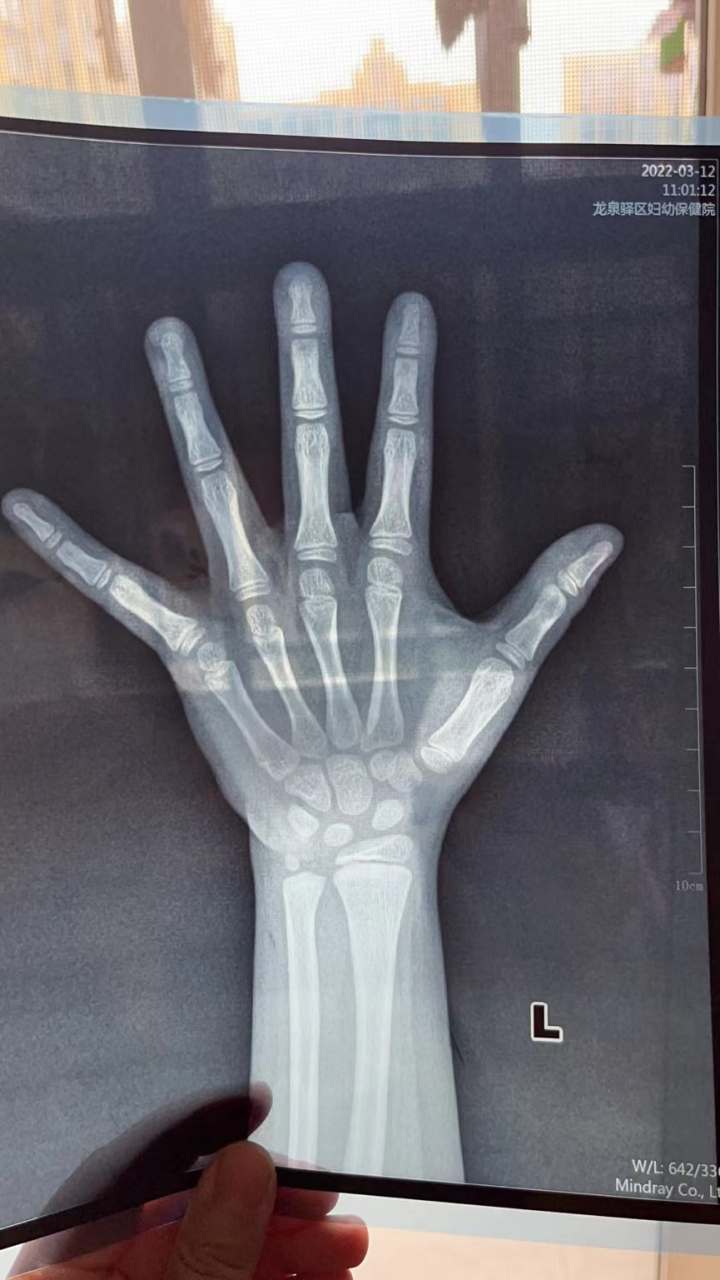 9岁女孩,身高128公分,骨龄8.