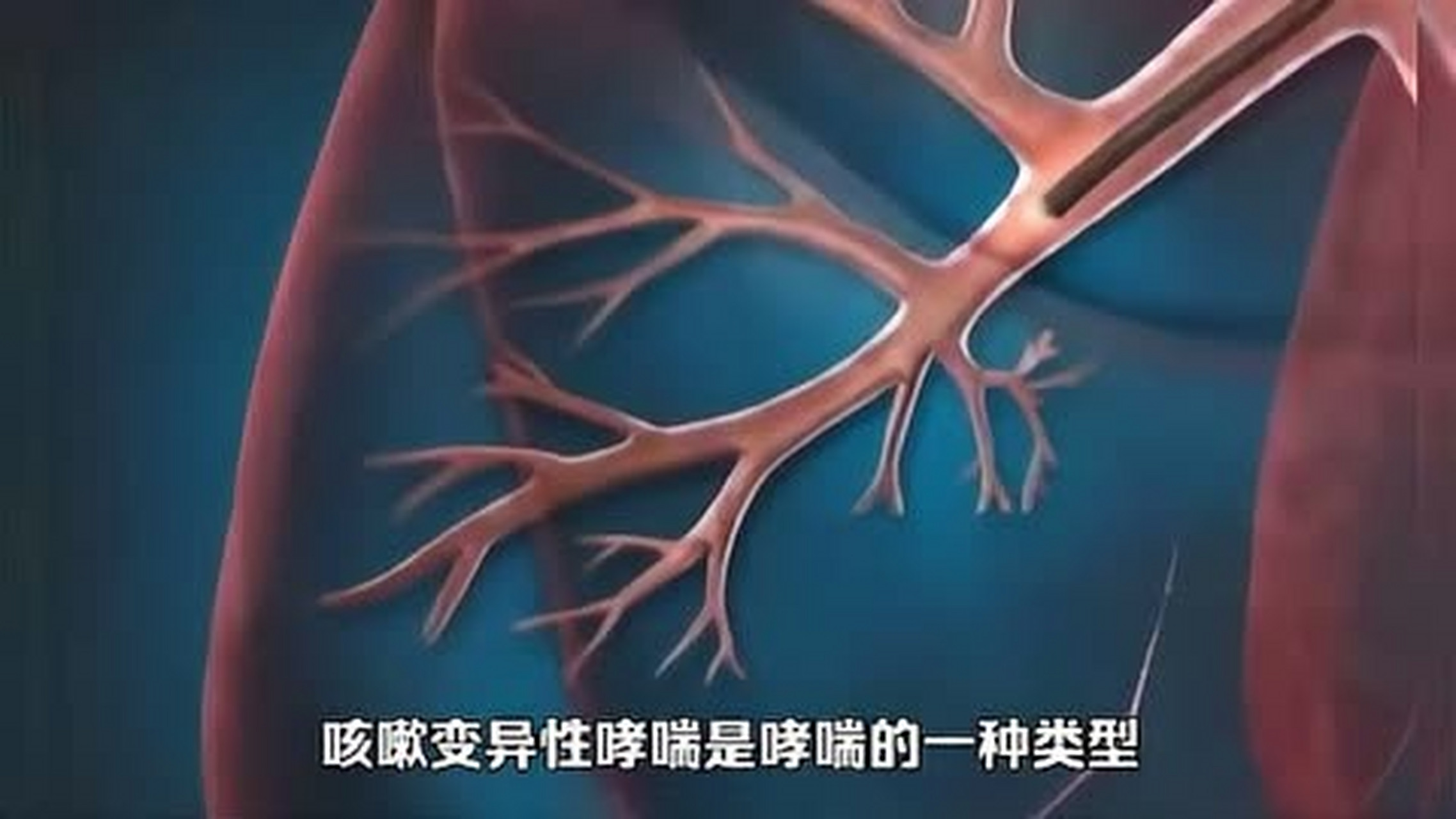 咳嗽变异性哮喘是一种持续性的哮喘,通常以干咳为主,咳嗽剧烈,夜间