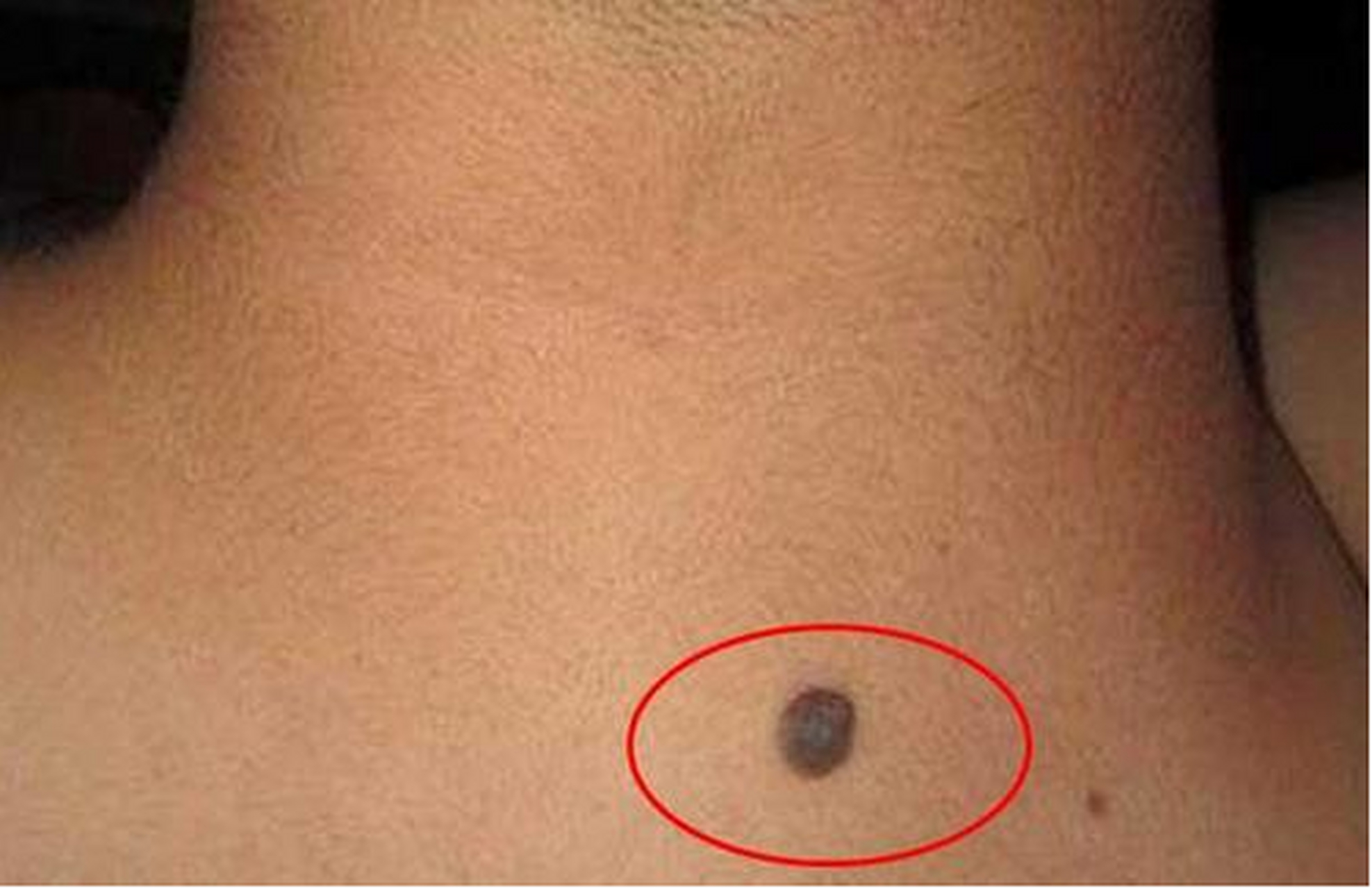 从他所发的图片来看,黑痣还比较小,但从肉眼来看,一些细节看的并不