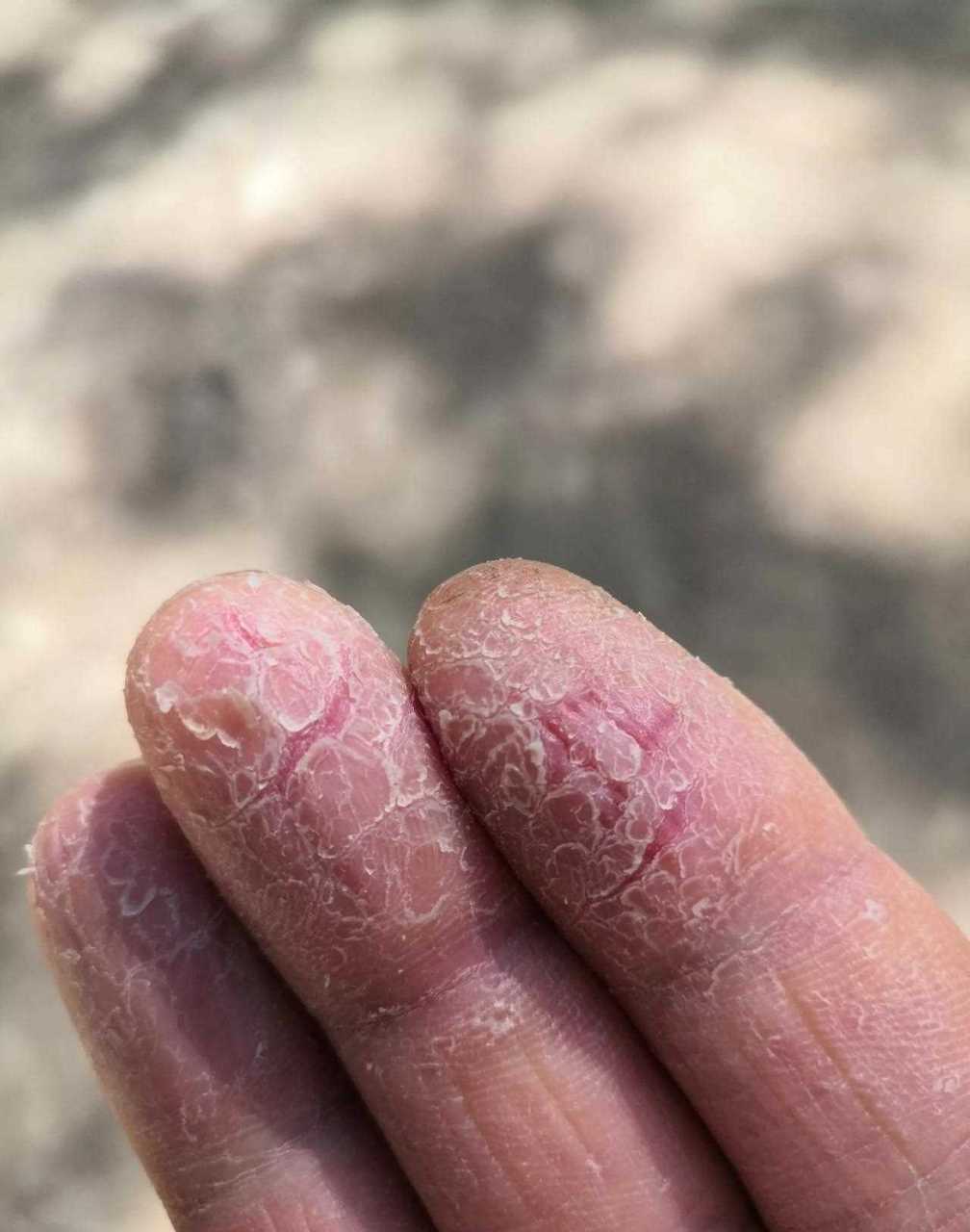 每年,手都会蜕皮,这几天严重了点,老皮蜕去,新皮还没有长出来,昨天又