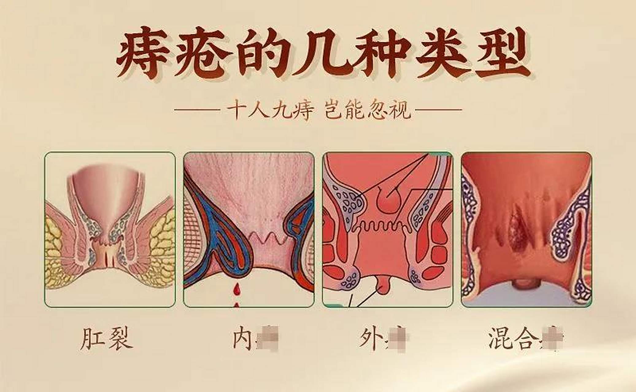 治疗痔疮,这6个中成药你一定要知道 1,槐角丸 具有清肠疏风,凉血止血