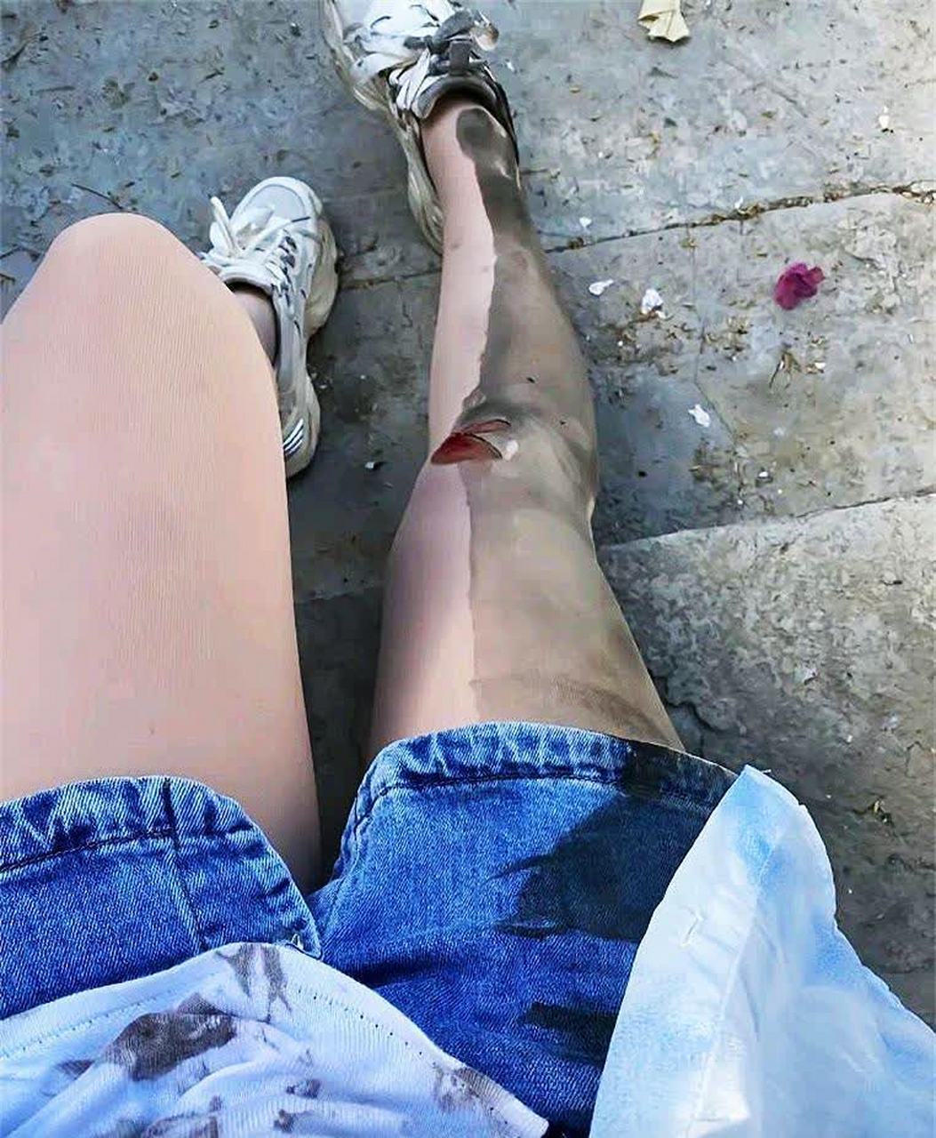 今天骑电动车摔倒了,膝盖受伤了. 如果男朋友误会我了怎么办?[抠鼻]