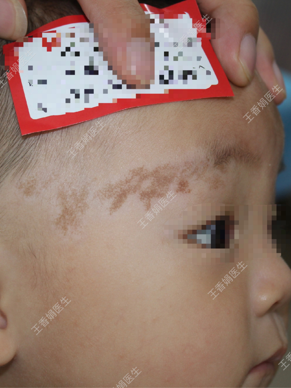 7个月的小宝出生时眉周就长有咖啡斑,家长一直为此苦恼,前后奔波多家