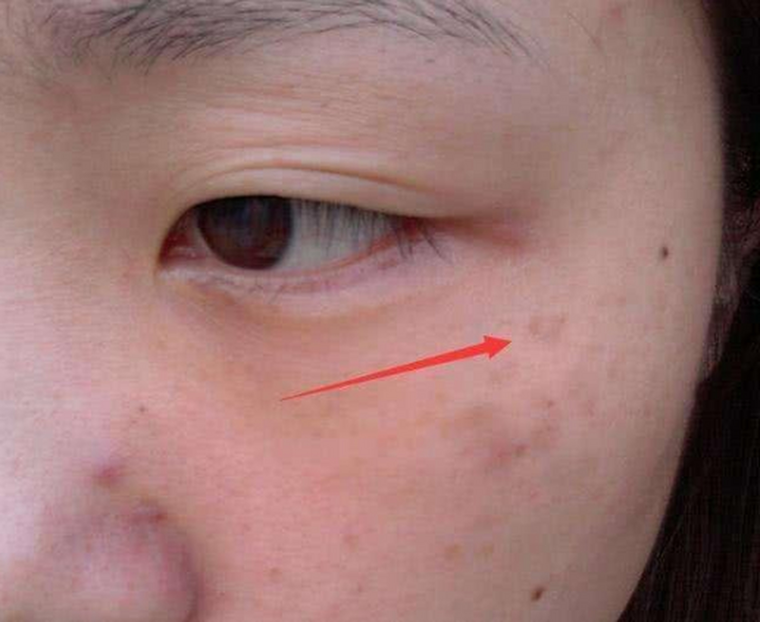 吃饭不香,脸上长斑,典型的肝郁脾虚 肝郁之后容易造成脾虚,脾气虚主要