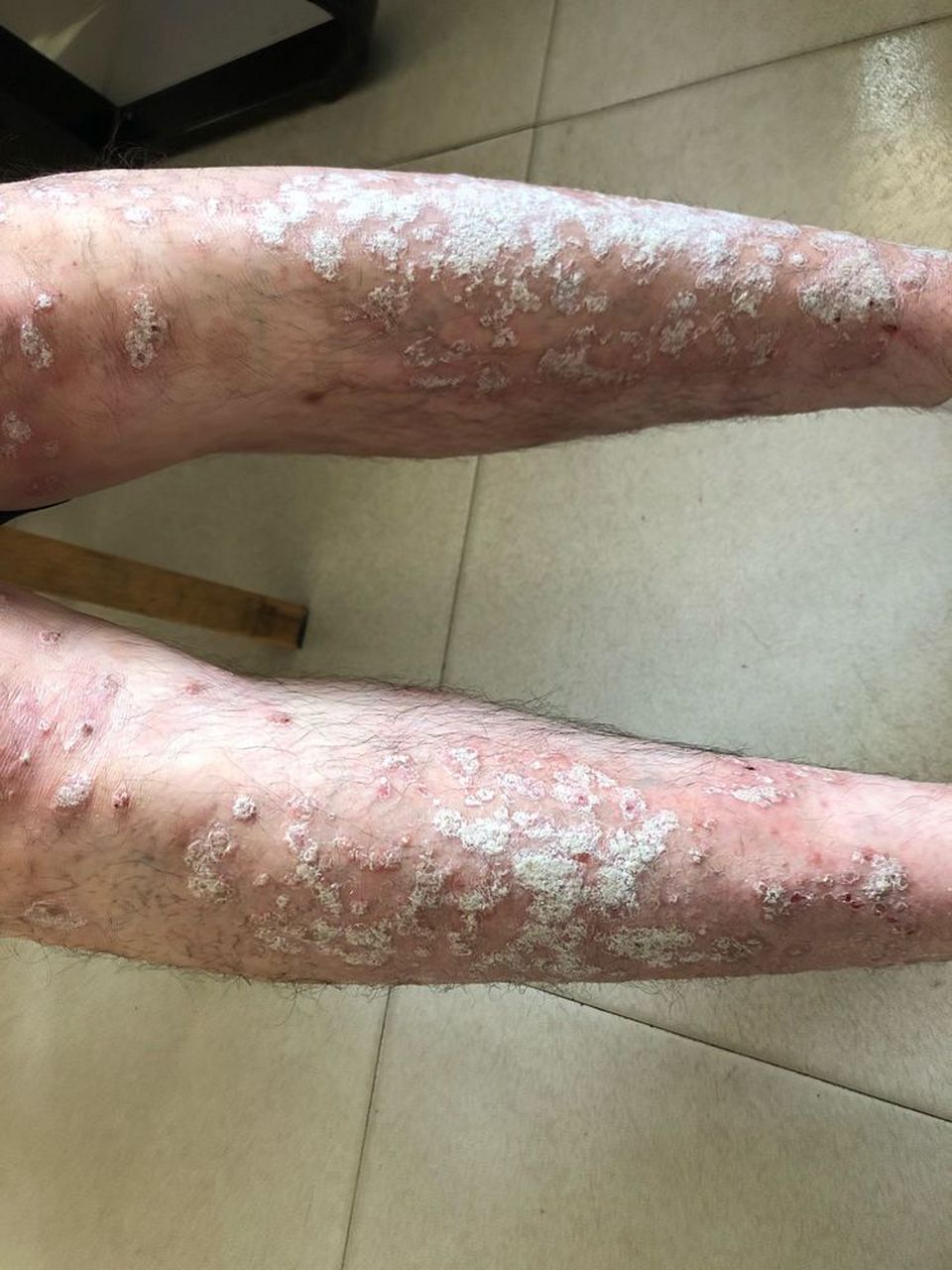 银屑病 一旦出现这种皮疹 ,就不能 再依赖清热解毒的方法进行治疗了