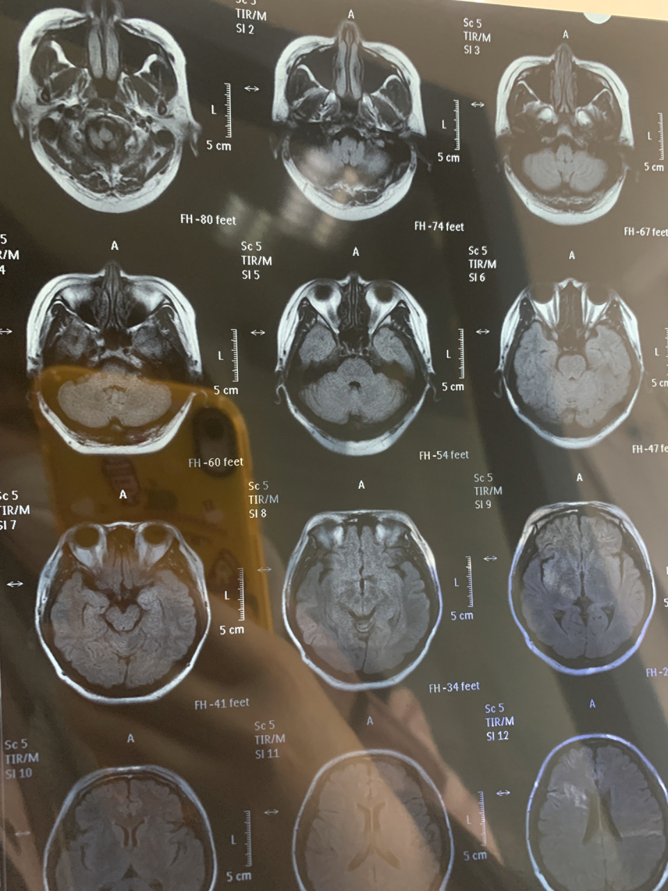这辈子不敢做了	因为头晕查不出明确病因,医生建议做脑部核磁共振检查