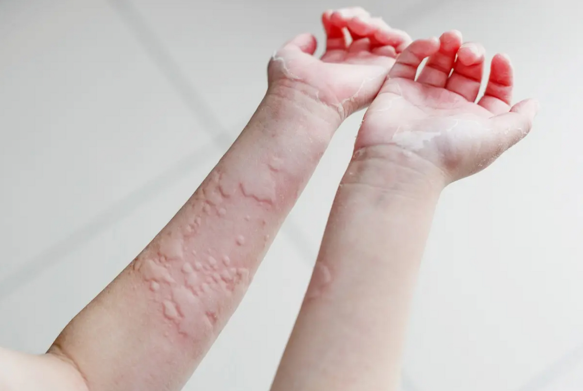 身上起了这种"鬼风疙瘩"来时瘙痒难忍,去时无影无踪