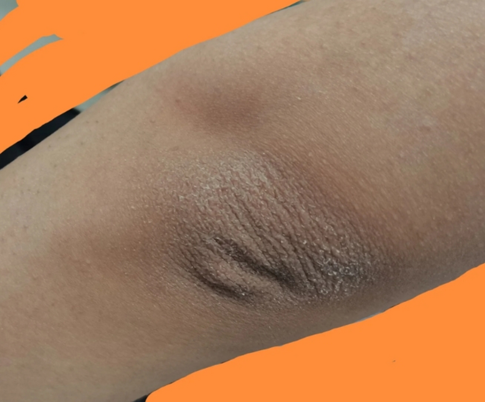 那么,有没有什么方法可以快速去除胳膊肘上的黑色素呢?