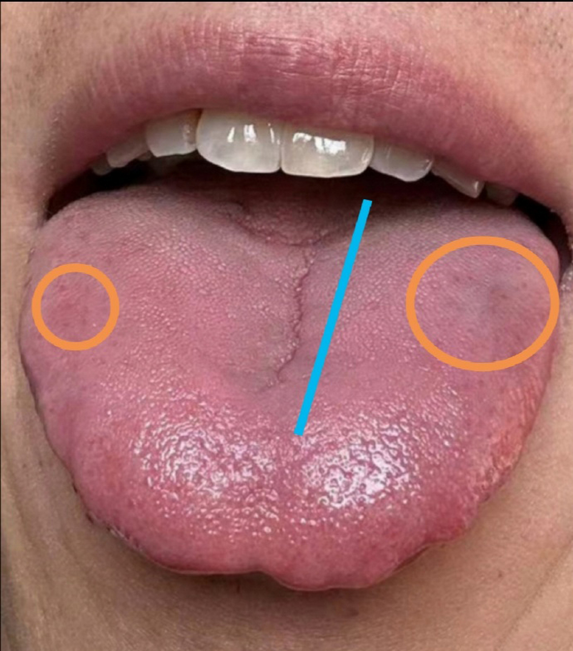 黄色圆圈代表淤血点,肝郁了气血瘀滞.舌头中间有裂纹,代表脾胃虚弱.