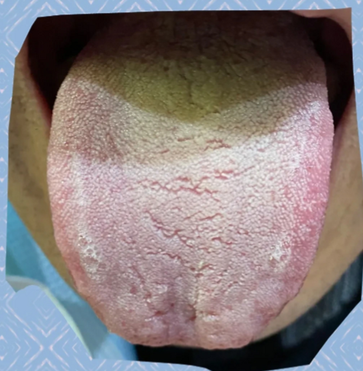 舌苔又有白又有黄,到底是不是湿热?