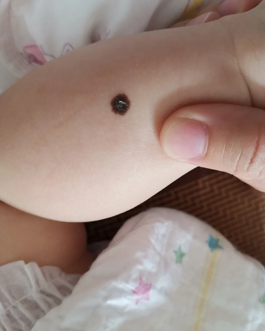 孩子身上的痣出现这4种情况,有癌变的风险!