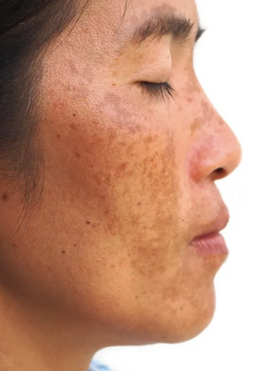 激光祛斑# 脸上长了褐色的斑怎么办 脸上出现褐色斑点,可能是因为