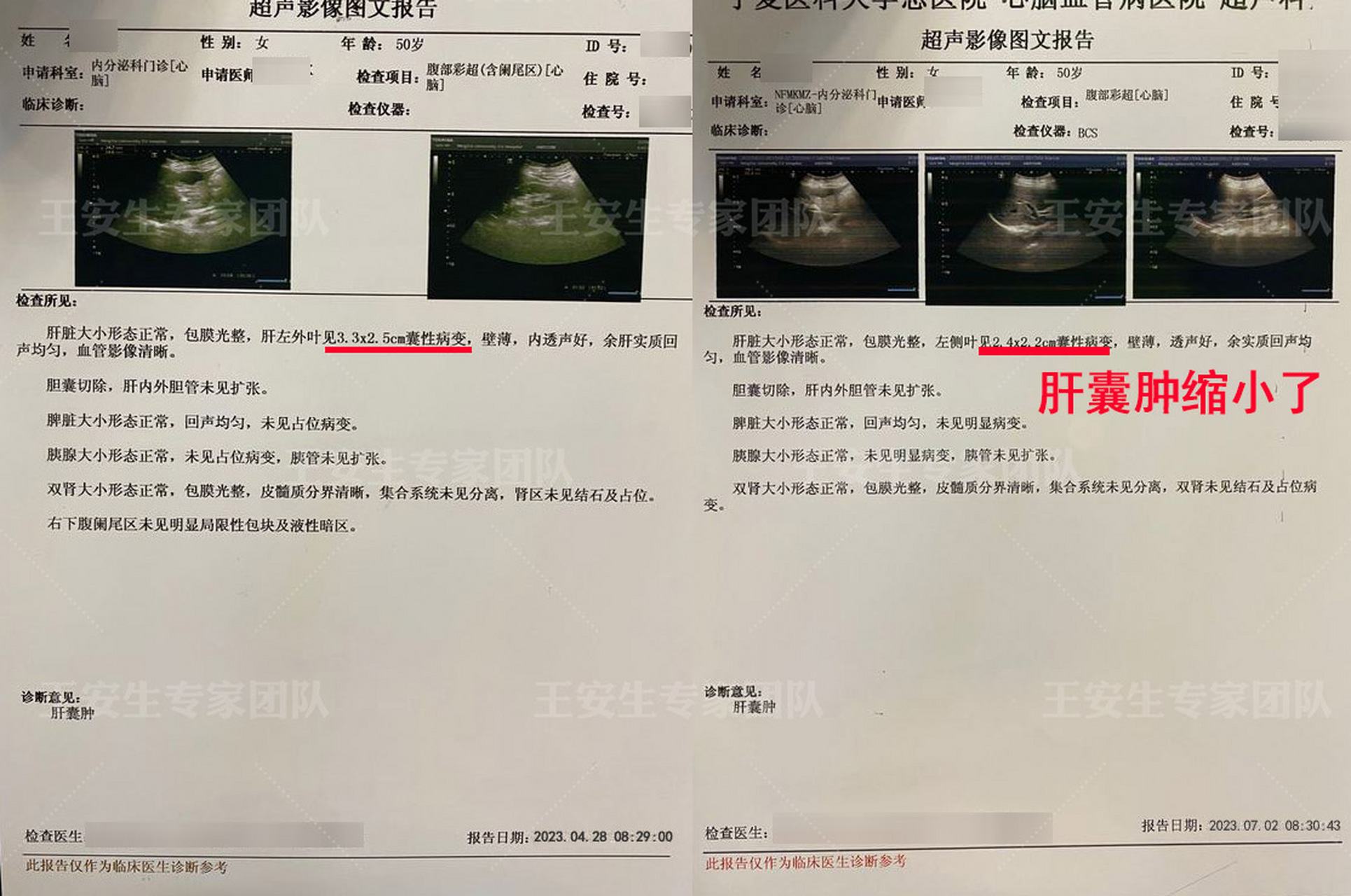 50岁患者周女士查出肝囊肿每年都有长几毫米,乏 眼干涩,失眠,脾气急