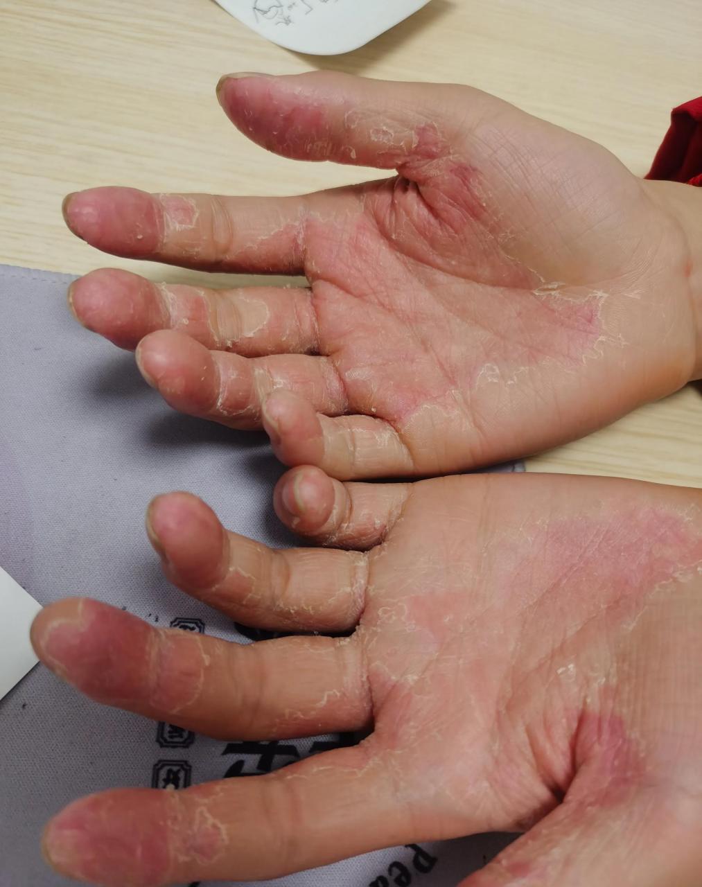 如果单看疹子形态确实很像,都是干燥,脱皮.