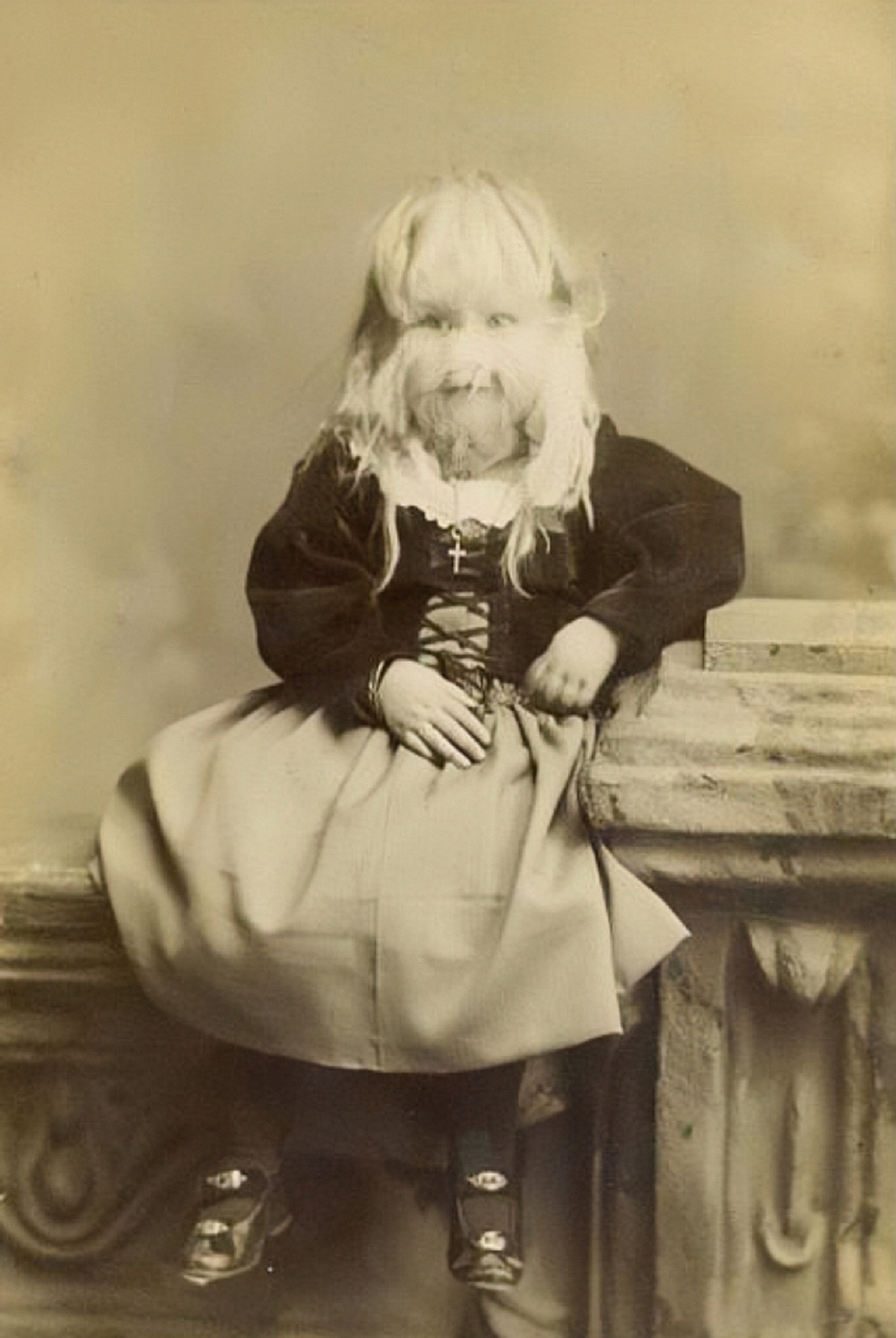 百年前,患有"多毛症"的美国女人.