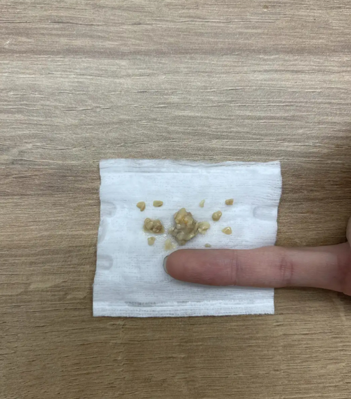 今天喉咙不舒服抠出这玩意儿,这是个啥?[汗]