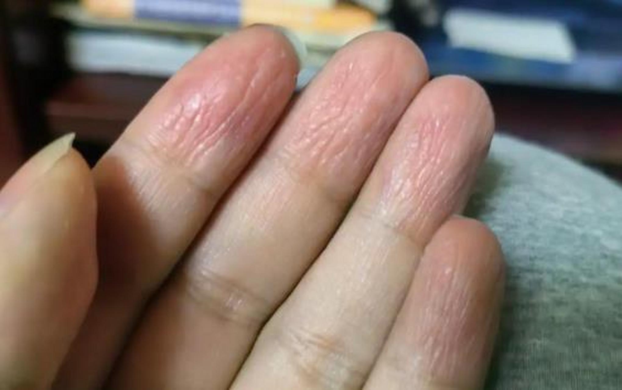 手指起皮指纹都看不见了,有什么方法治吗?