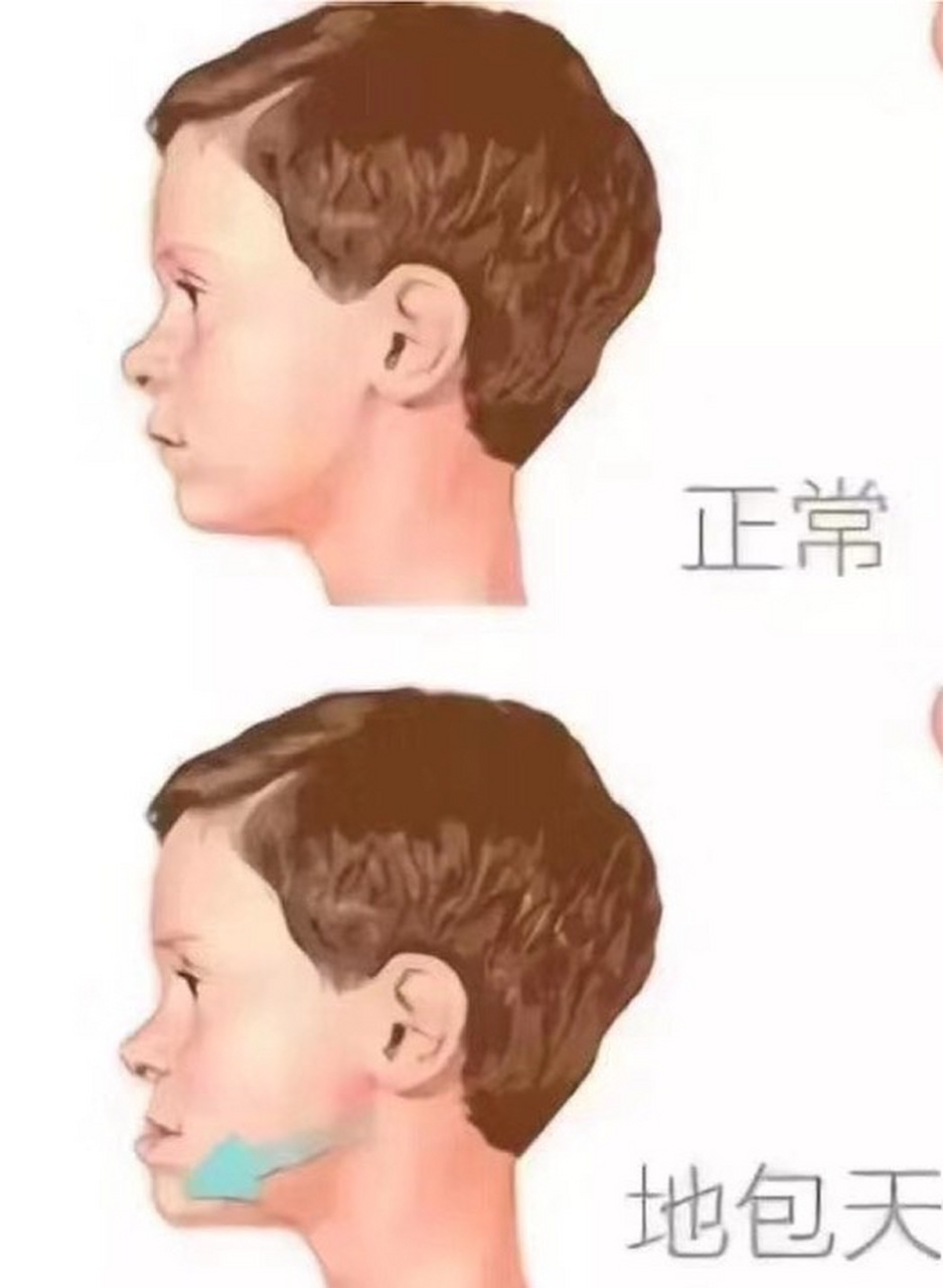 女孩地包天多大年龄矫正最好?