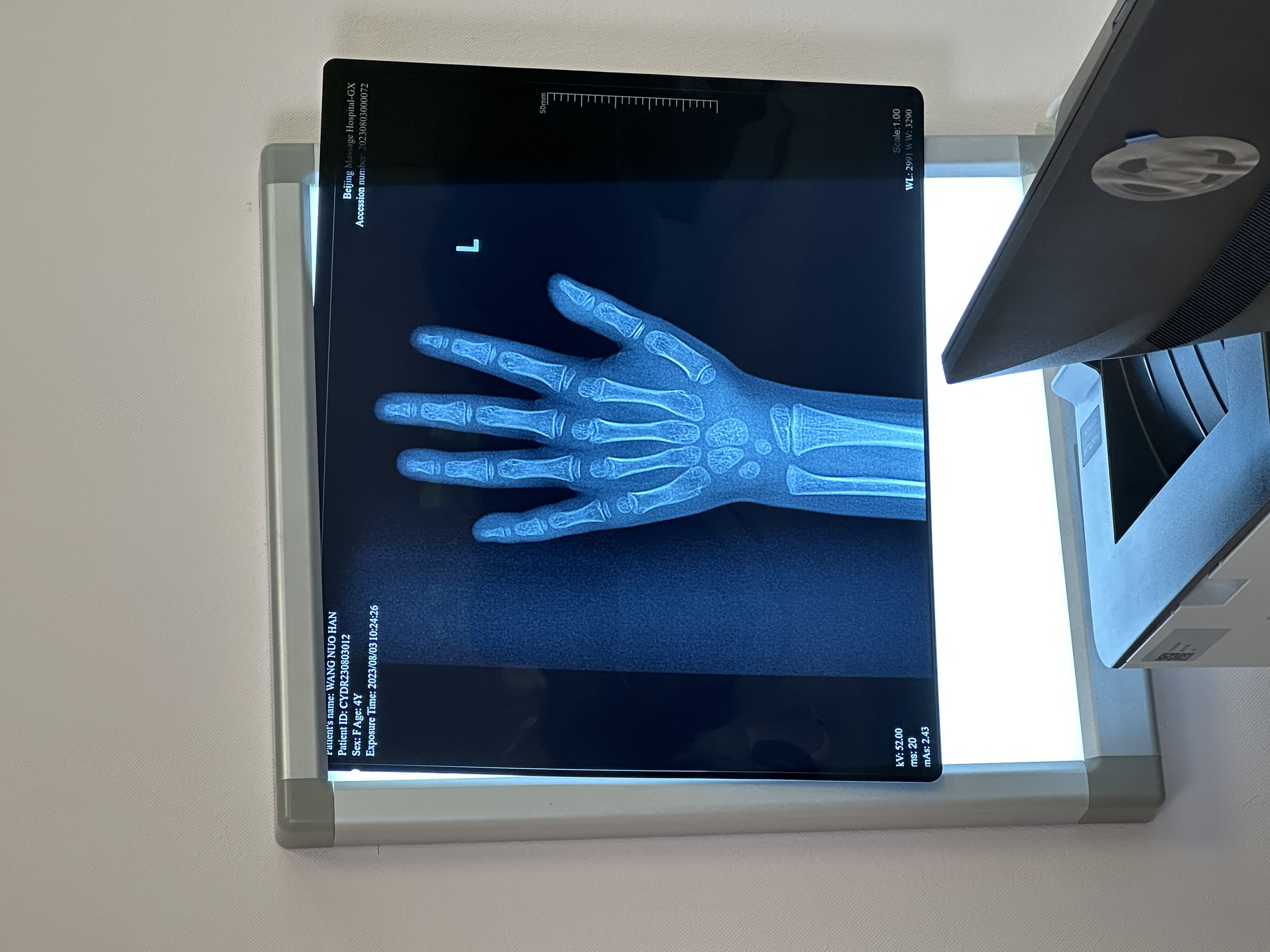 1cm,体重31斤,骨龄才4岁