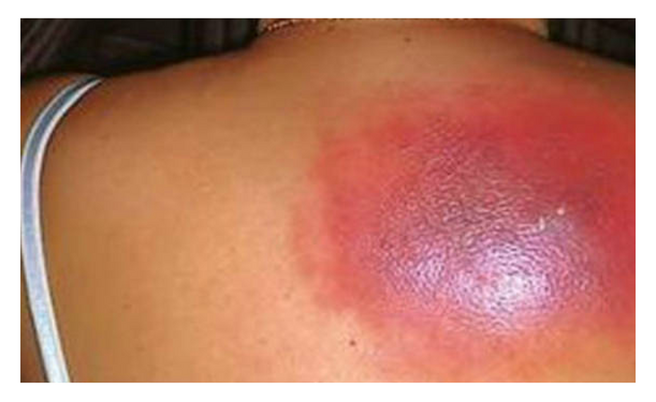 后背突然长了个包起来,卫生服务站的大夫说是粉瘤,让去大医院做个