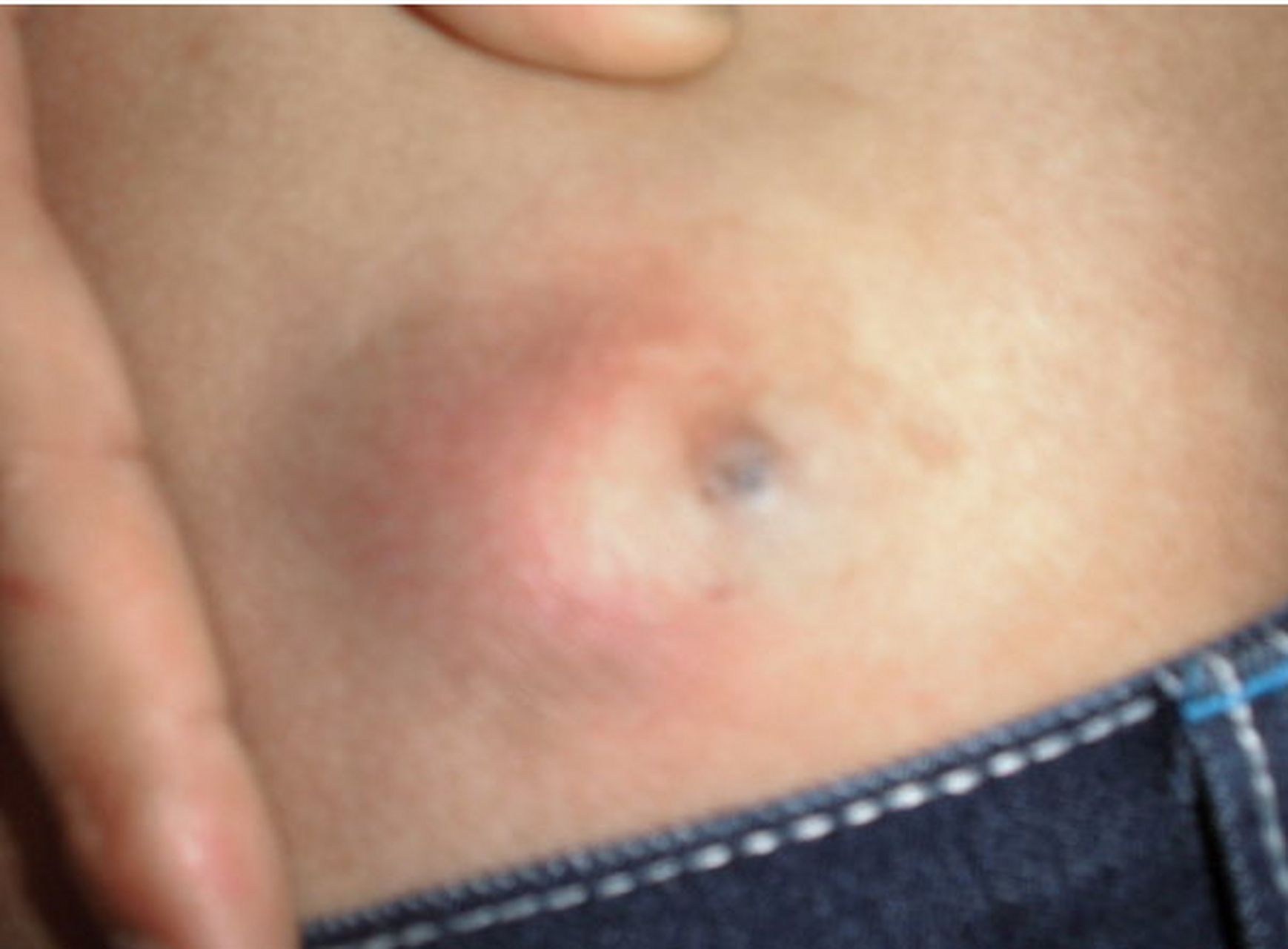 女性屁股上的脂肪瘤图片
