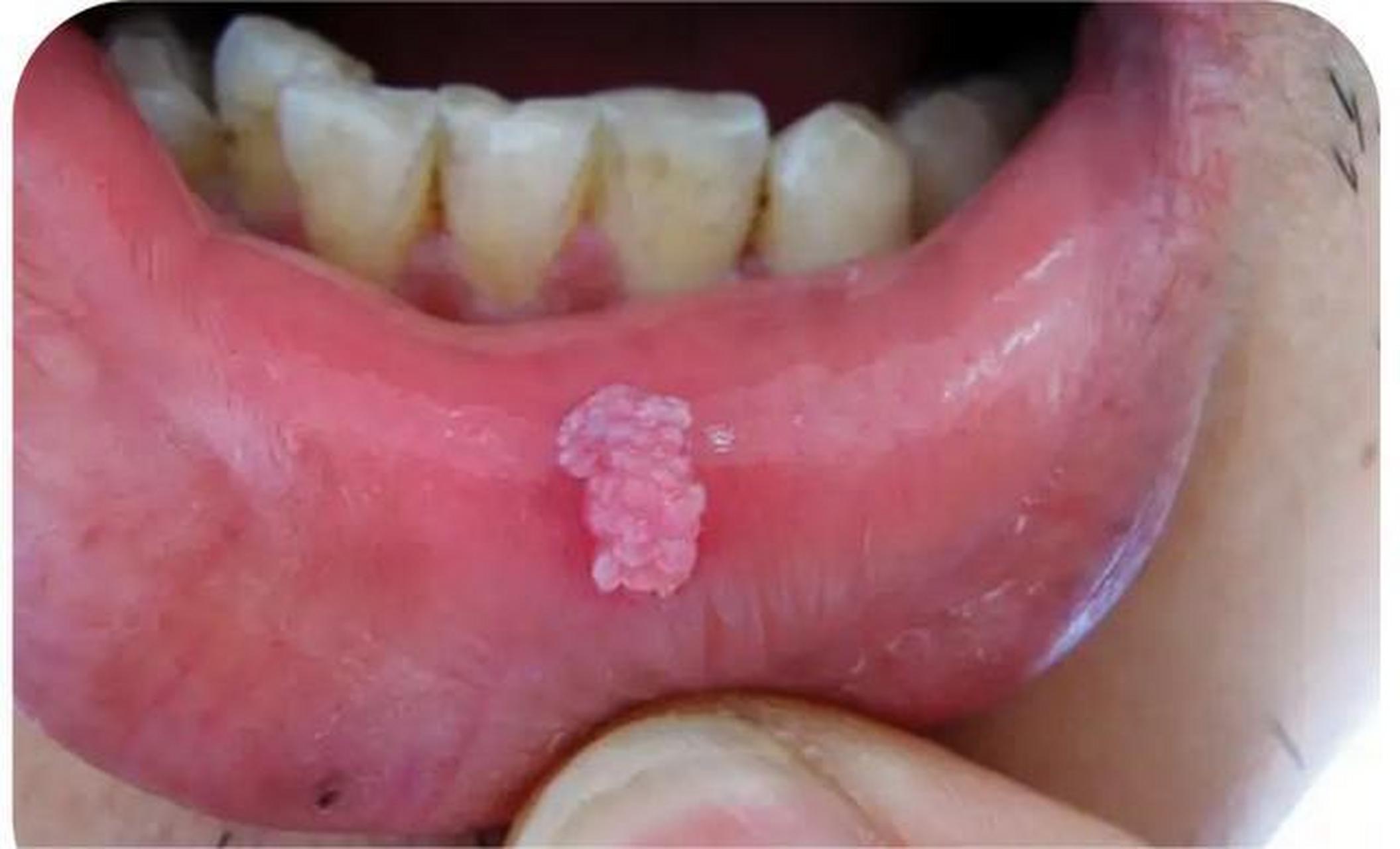 尖锐湿疣,它是一种性传播疾病,主要的发生部位是在私处,肛周等部位