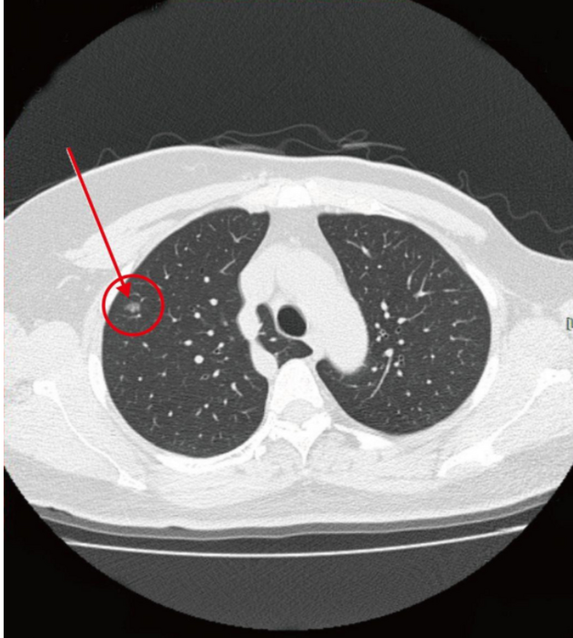 7mm磨玻璃结节,三个月后复查4mm,用对方法很重要!