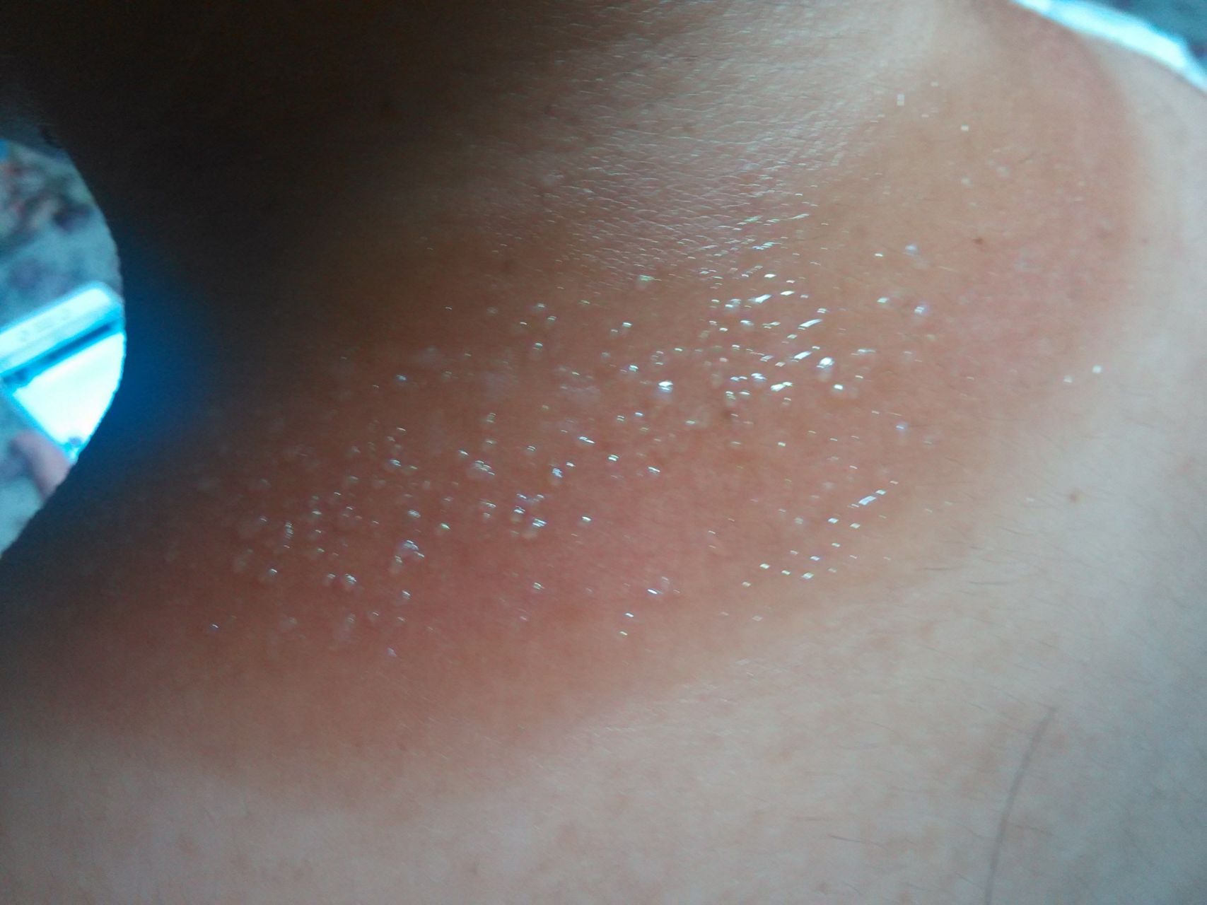 光敏性皮炎# #皮肤病# 光敏性皮炎主要是由于患者皮肤对太阳光产生