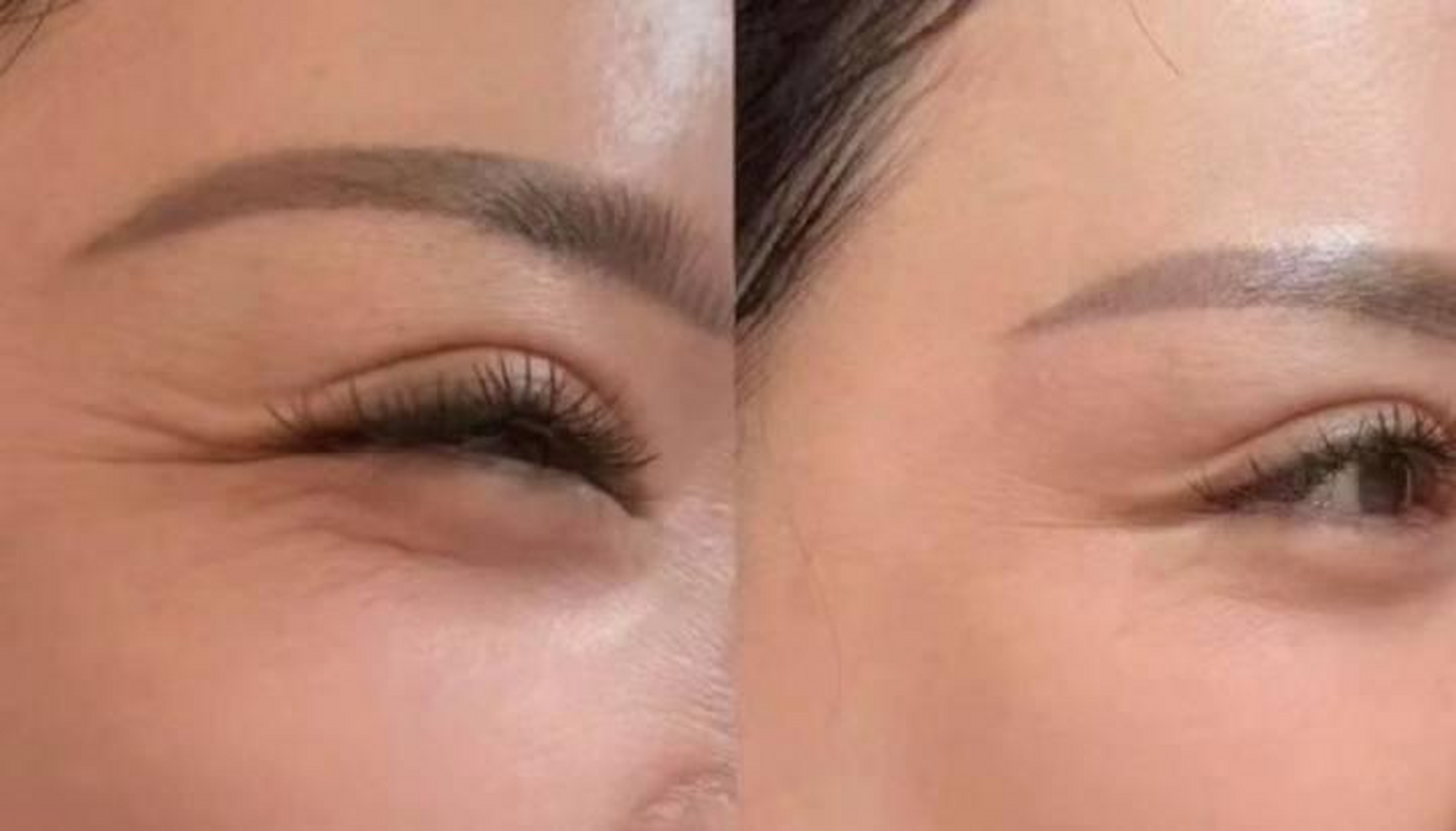 最近有一位求美者来医院问我,30岁了可以做鱼尾纹除皱吗?