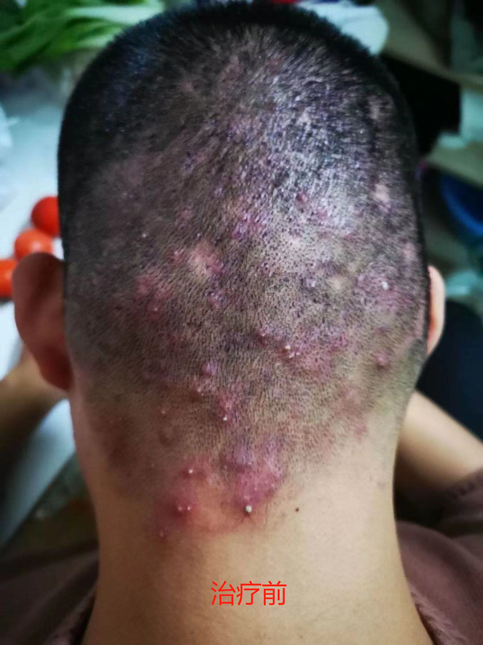 后脑勺头皮红肿长满脓疙瘩,中医辨证支招,想不好都难!