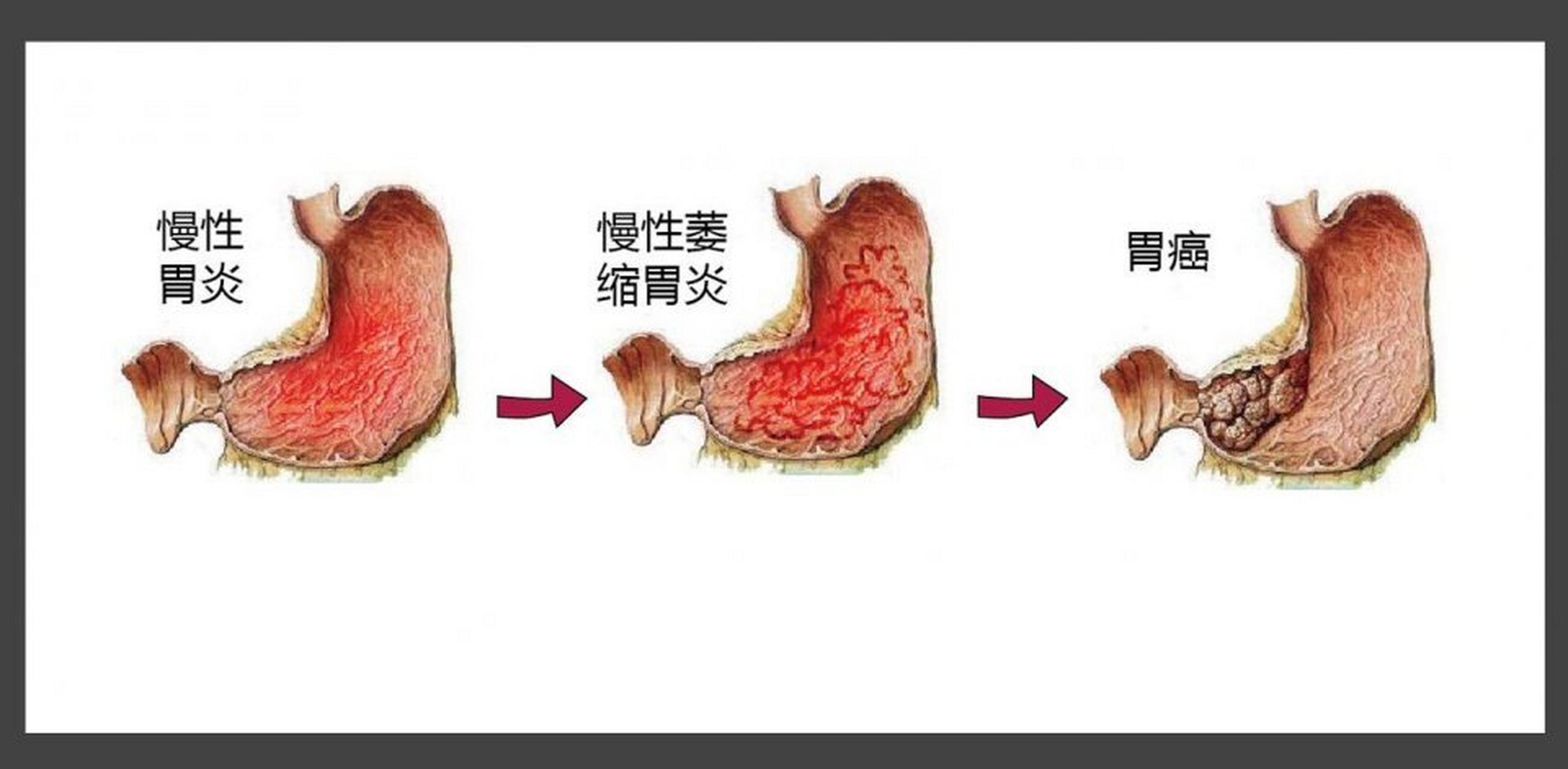 萎缩性胃炎严重吗图片