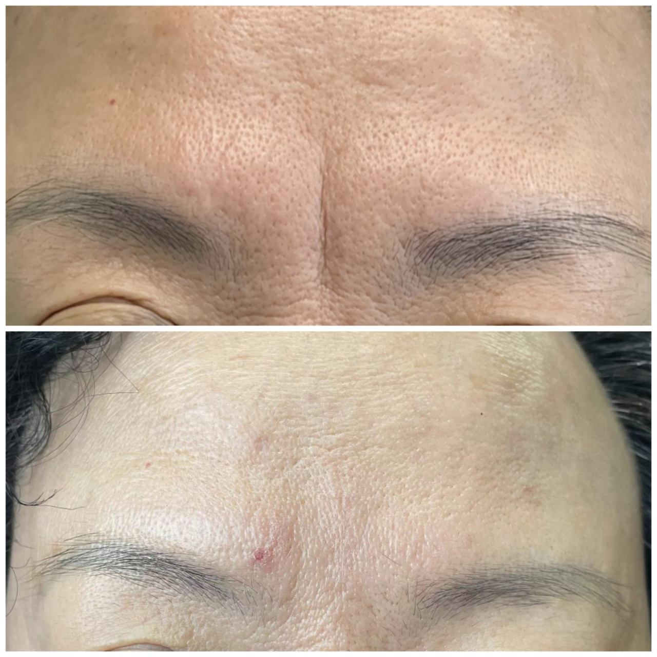 对许多人来说,悬针纹却影响了他们的自尊心和信心.