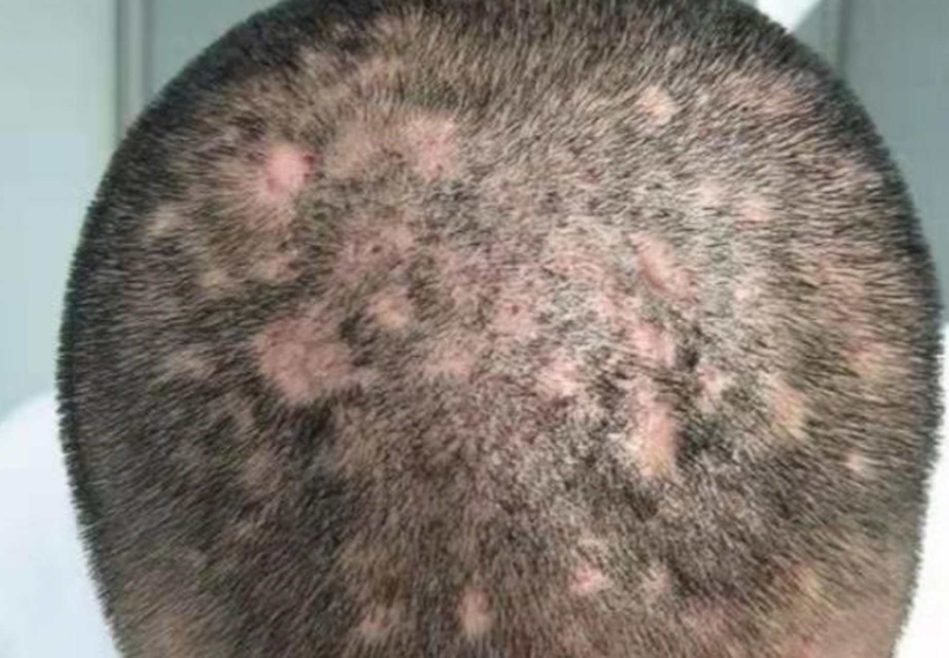 这位患者,毛囊炎伴脱皮,头上成这个样子了(见图1) 通过中医问诊发现